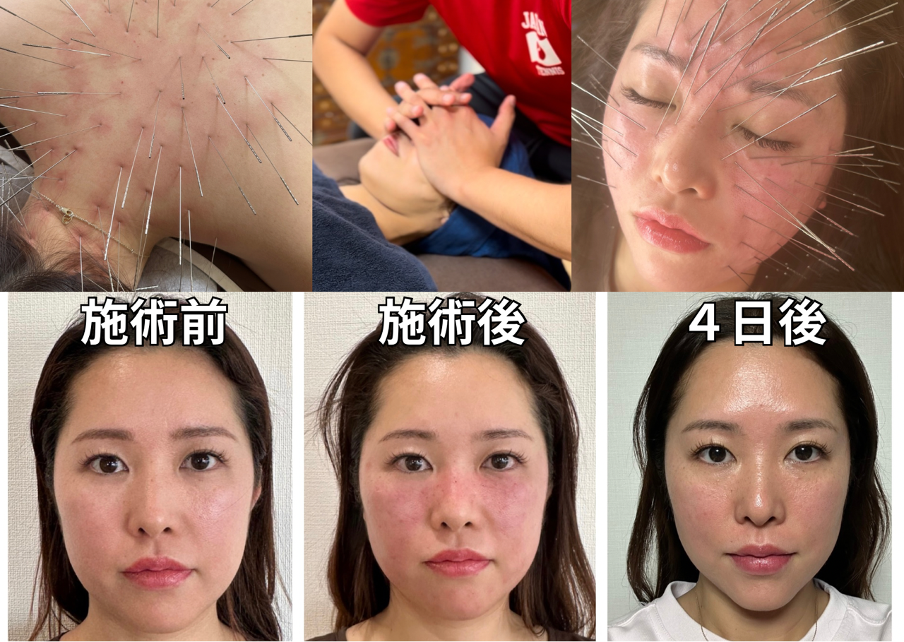 鍼処SHIRAKAWA阪神院【兵庫・西宮｜ 岡山・奈良・東京出張｜ルート治療｜自律神経・慢性症状専門｜小顔矯正】 顔魂ルート〜切らない整形〜（ルート治療×小顔矯正×鬼美容鍼）のメニュー画像