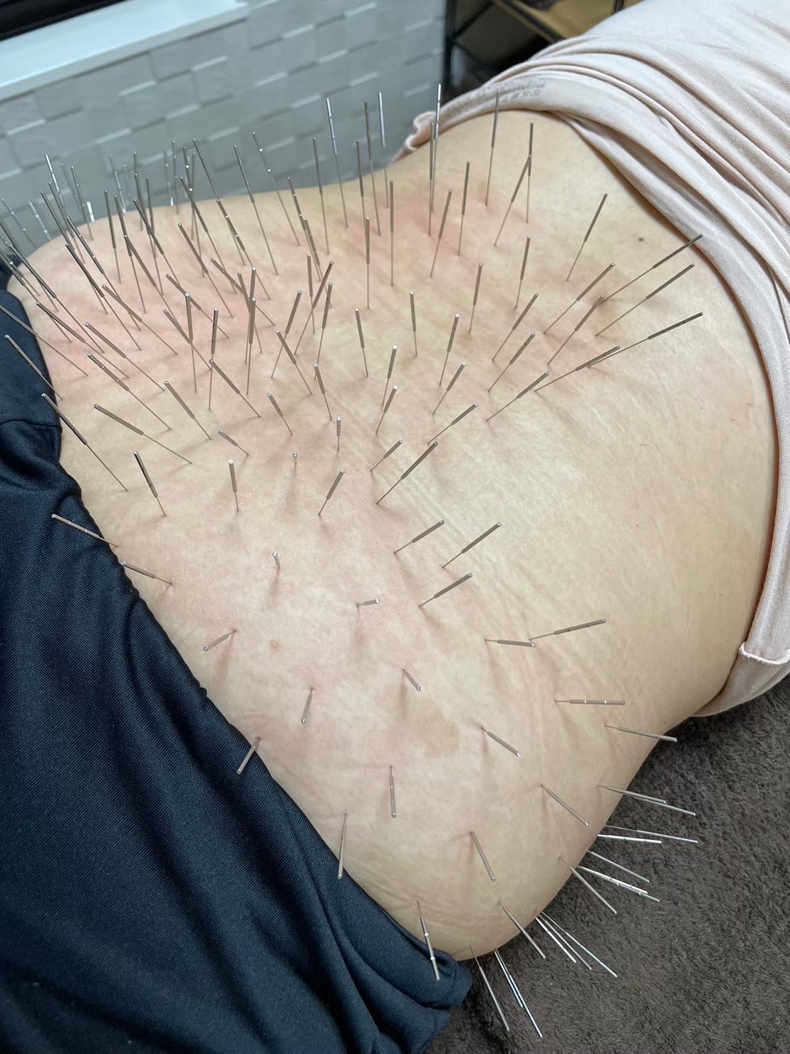 鍼打人　Aomori    ルート治療 婦人科集中コースのメニュー画像