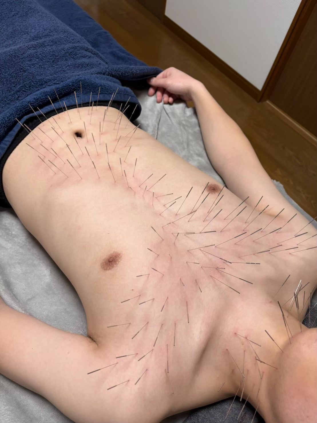 鍼打人　Aomori    ルート治療 学生さんコースのメニュー画像