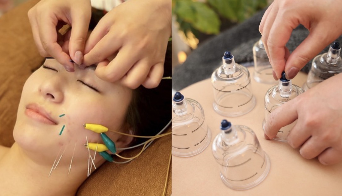 鍼灸サロン Hari-Cure 【2月限定】美容鍼＋疲頭鍼＋カッピングのメニュー画像