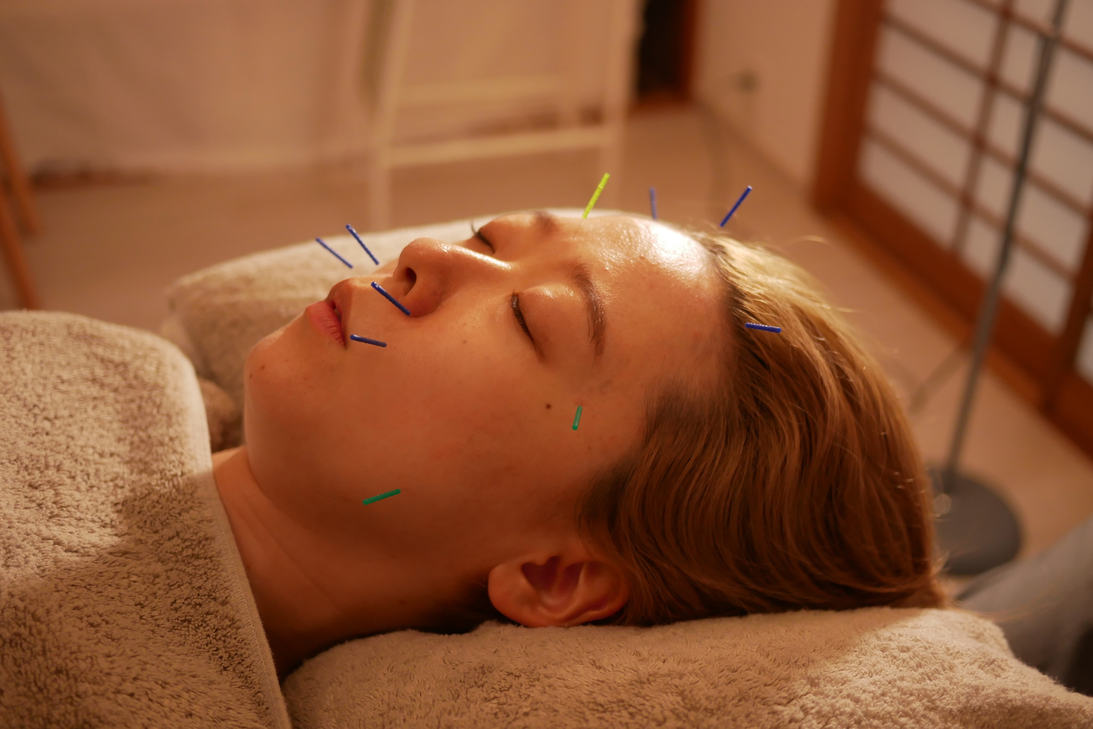 鍼灸マッサージ 眠り猫 美容鍼 (30分)のメニュー画像