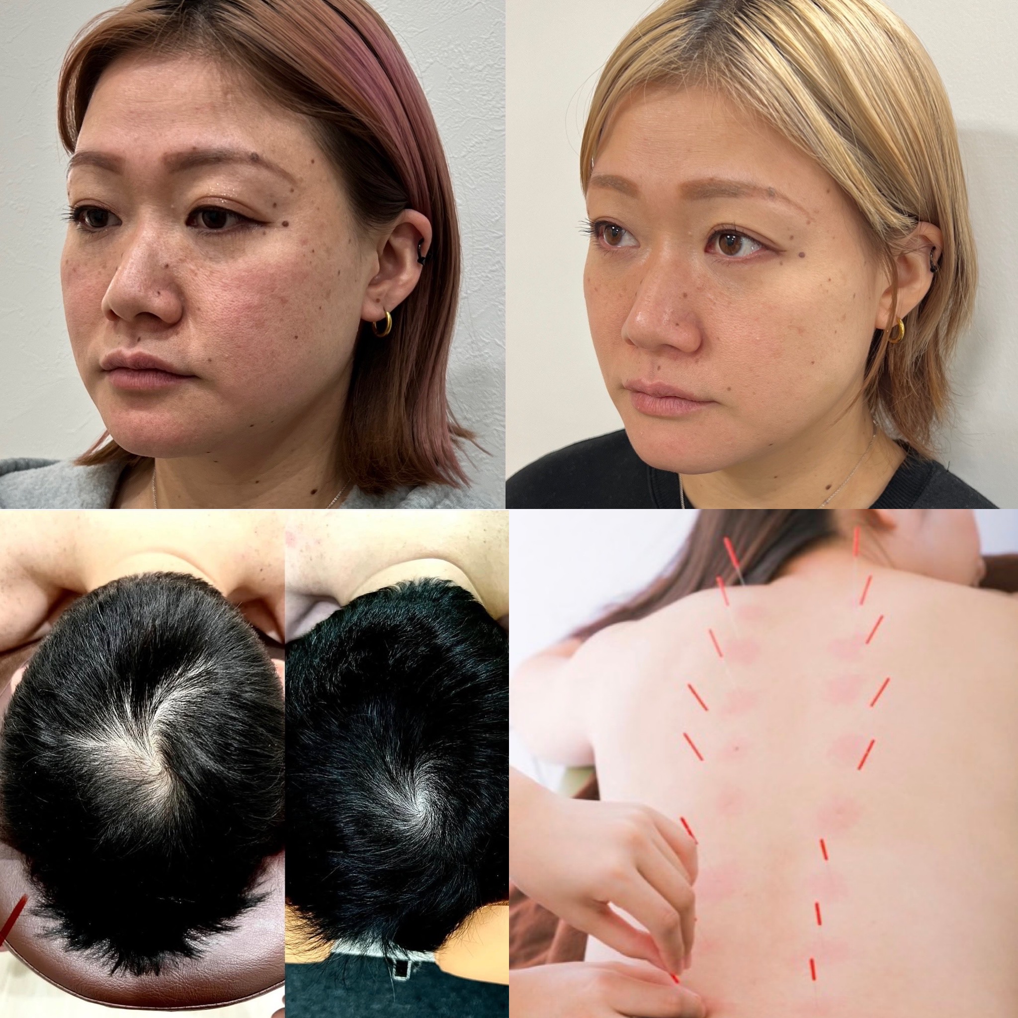 たいよう鍼灸院（八日市/薄毛鍼/美容鍼/特化型鍼灸整骨院） 顔も、頭も、体も。 全部まとめて整える。  【人気No.2】まるごとルート治療  「忙しくて何度も通えない」 のメニュー画像