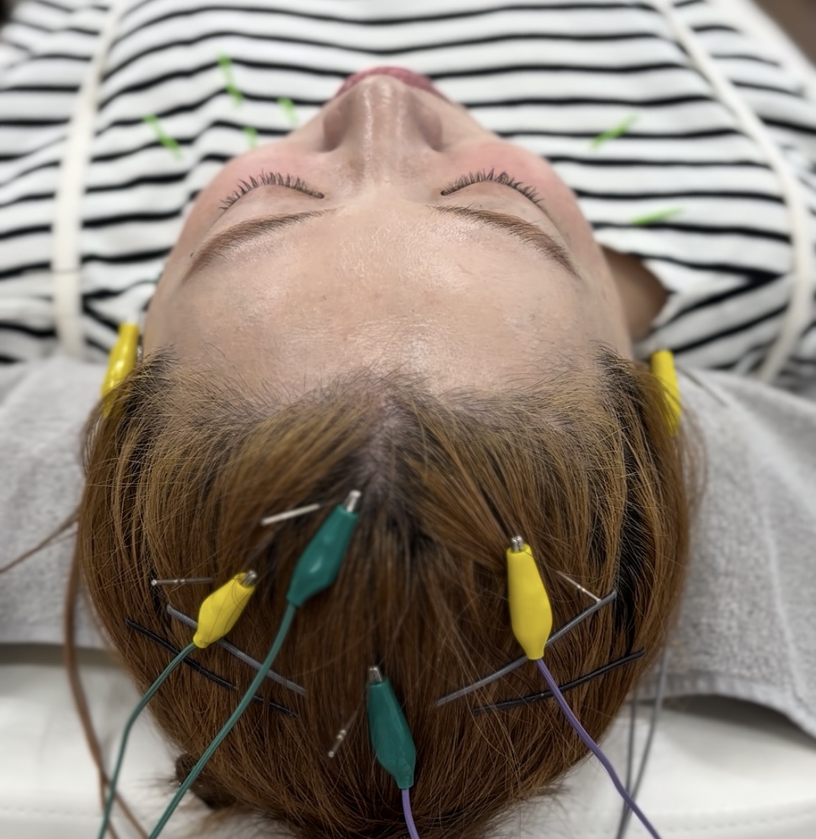 鍼灸サロン　shiro 【初めての方】美容鍼・頭皮鍼のメニュー画像