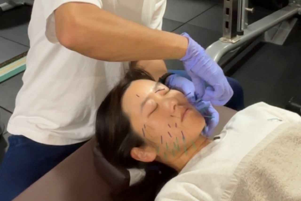 浦添てるてる鍼灸整骨院×teru.fit 美容鍼（肌質ケア）30分のメニュー画像