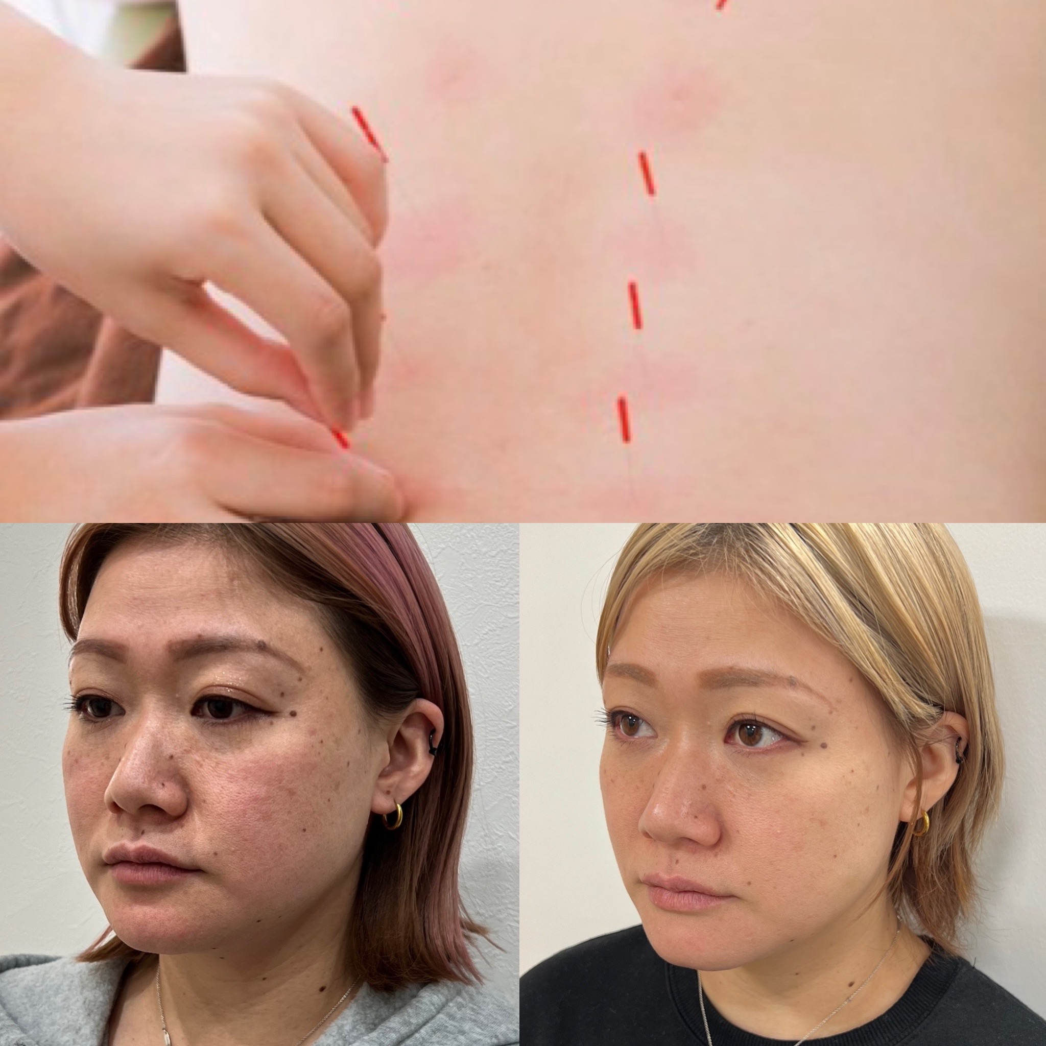 たいよう鍼灸院（八日市/薄毛鍼/美容鍼/特化型鍼灸整骨院） 鬼美容鍼ロングのメニュー画像