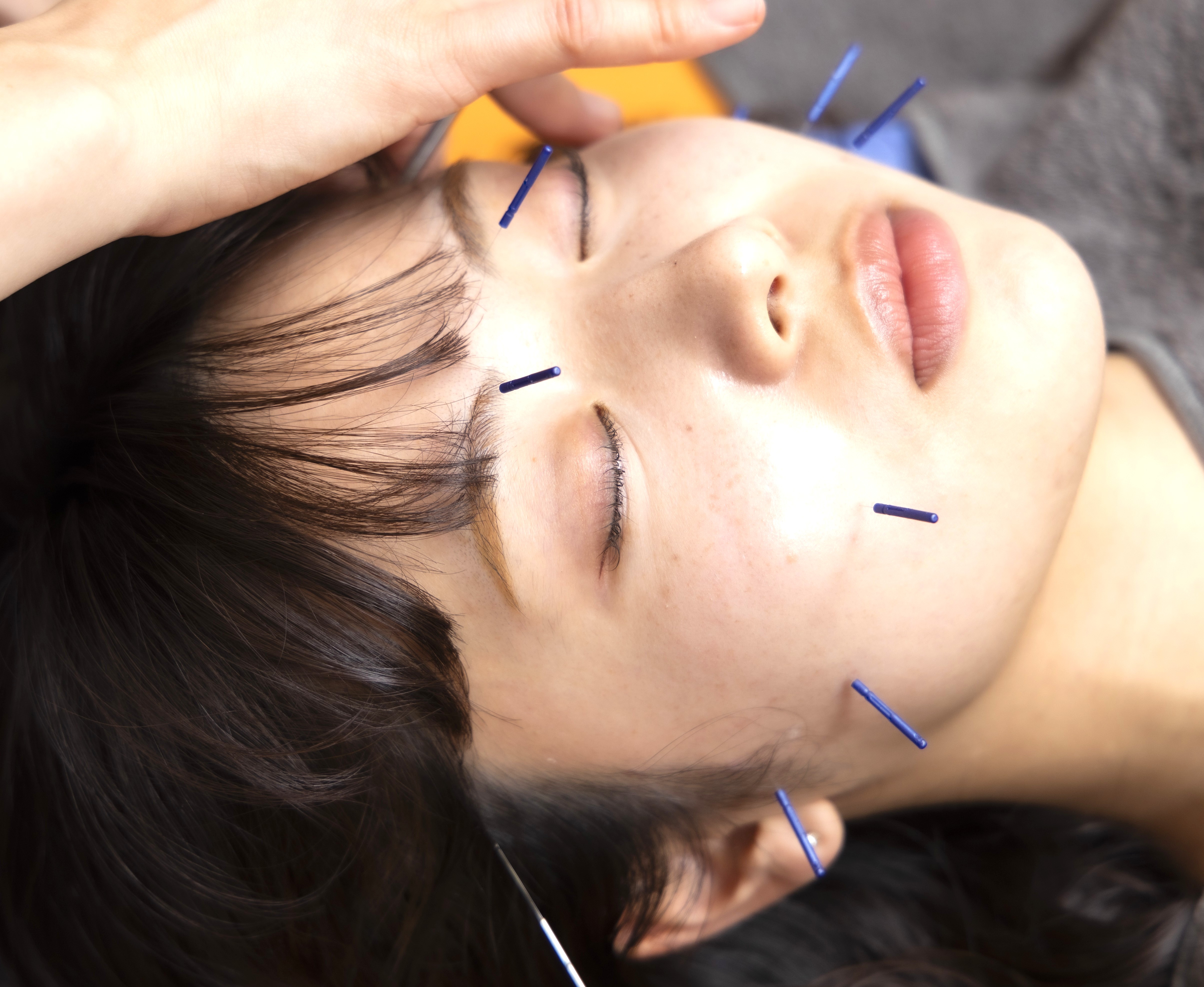 東垣鍼院 【リフトアップ】美容はり施術のメニュー画像