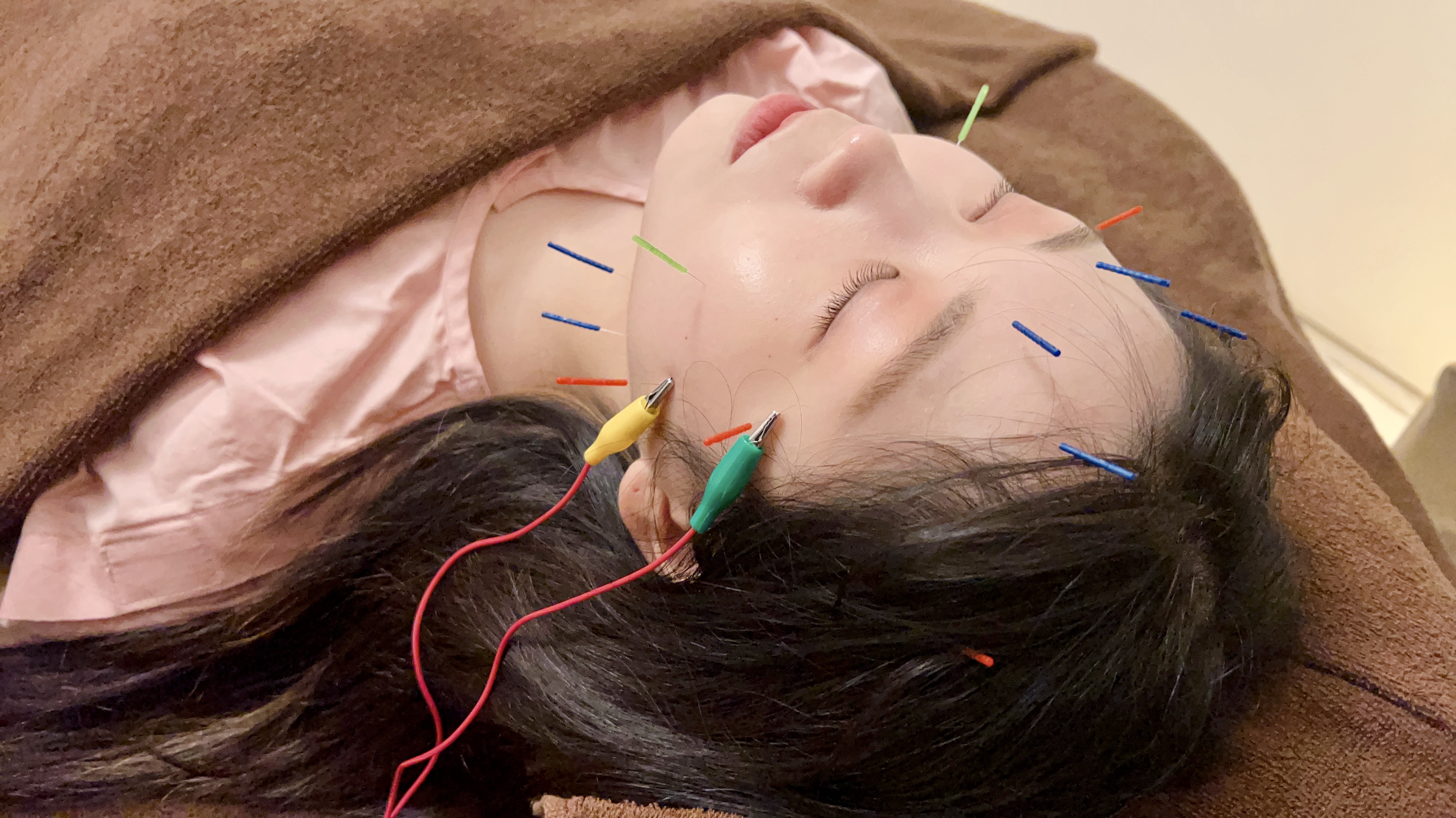 エステサロン&鍼灸院ROOM 肌のトラブルケア　美容鍼コース　40分¥6,000のメニュー画像