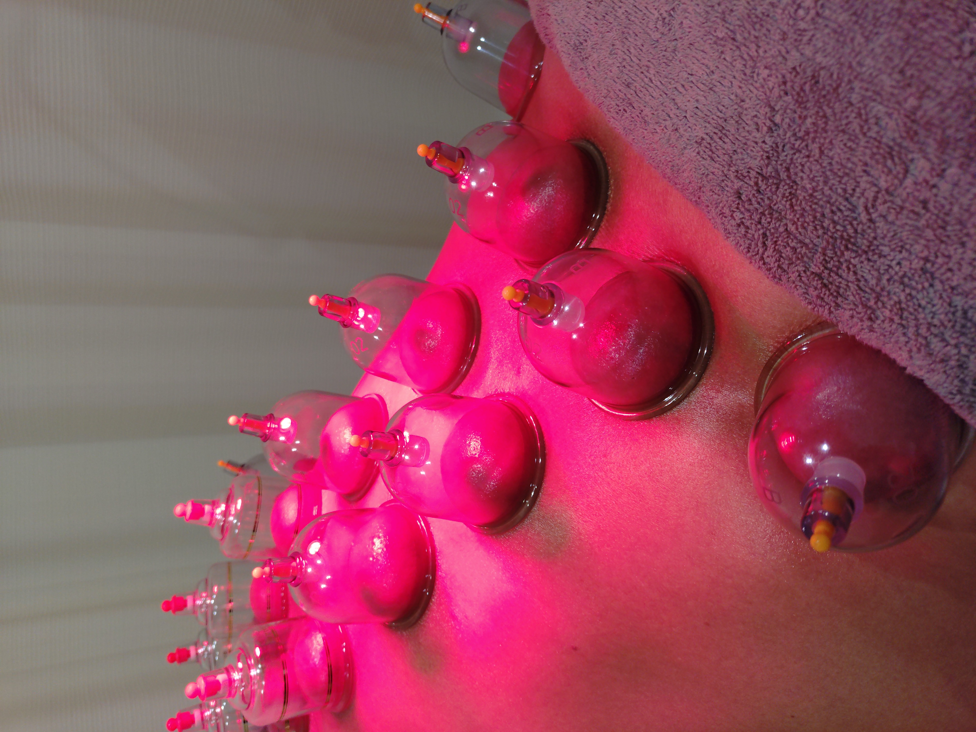 てらさき接骨院・鍼灸院 カッピング（吸い玉）療法(上半身または下半身)のメニュー画像