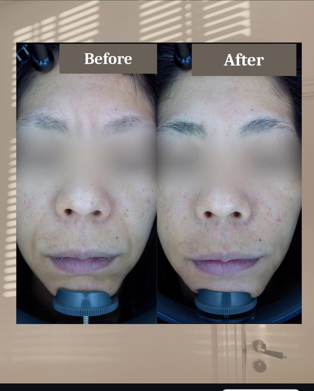 美容鍼灸サロン マックスビューティー シワ・たるみ改善プログラム　お試しコースのメニュー画像