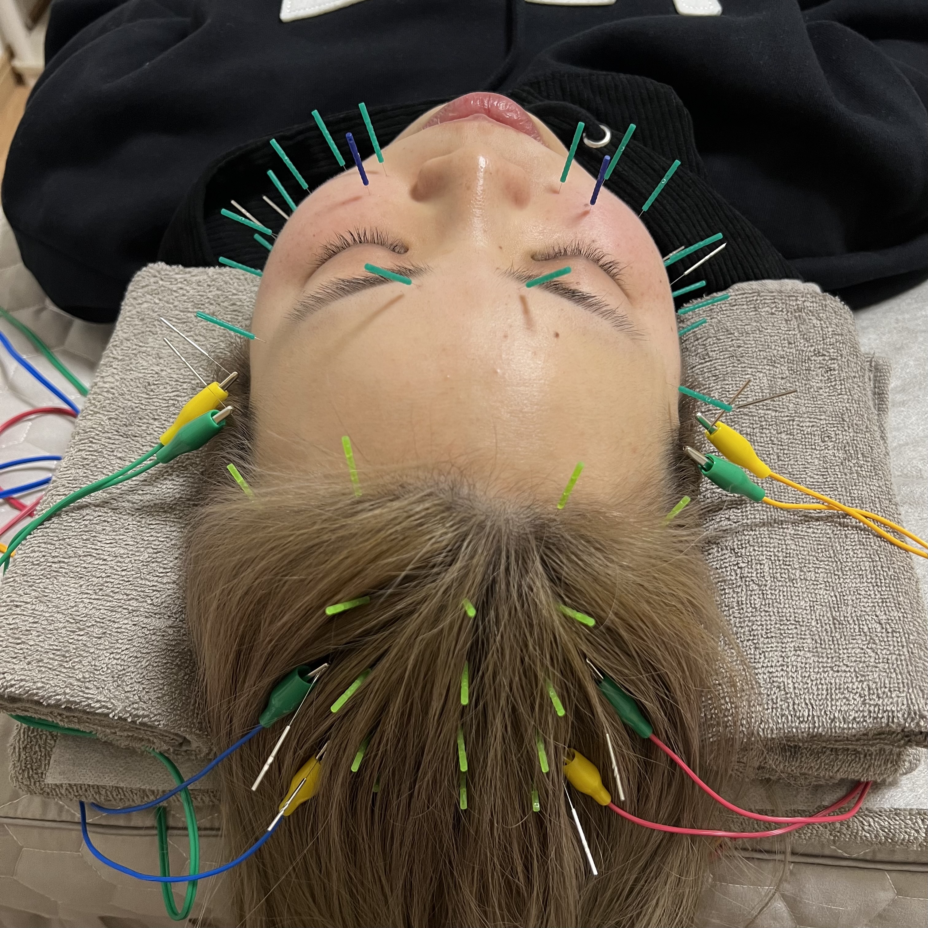 美容鍼灸サロンHaripure 【再来】自律神経リセット美容鍼のメニュー画像