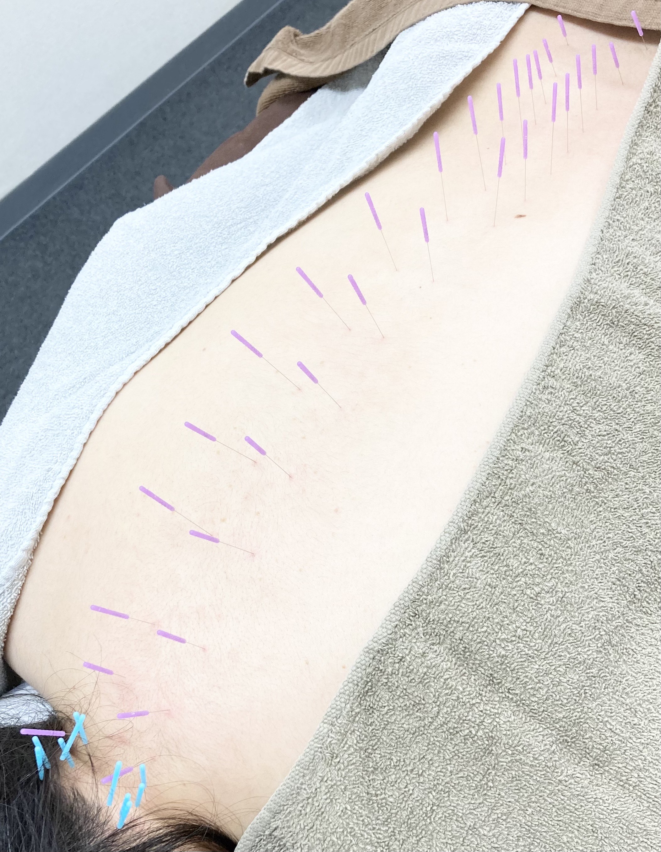 サボテン鍼灸マッサージ院 鍼灸マッサージ45分のメニュー画像