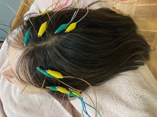 はりきゅうサロン結【更年期・妊活・自律神経ケア専門】 育毛鍼∔ヒト幹細胞培養美容液のメニュー画像