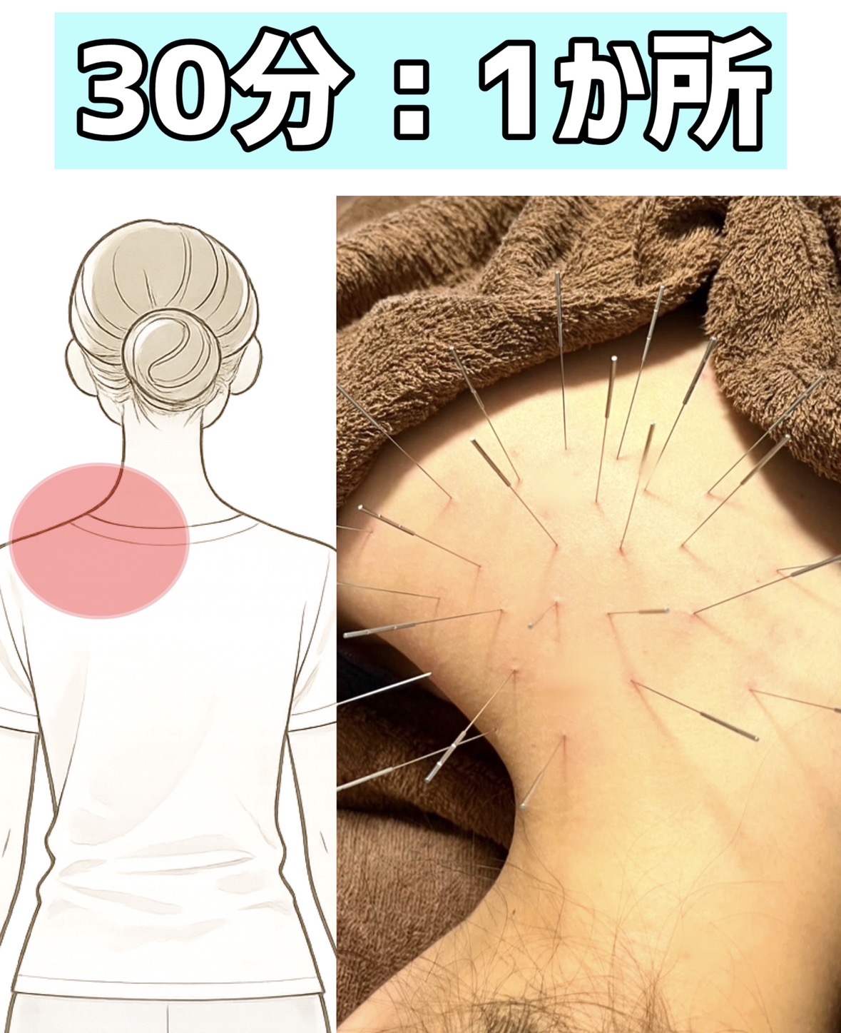 はり灸こころね 【部分ケア】まずは１か所のコリをピンポイントで軽くするのメニュー画像