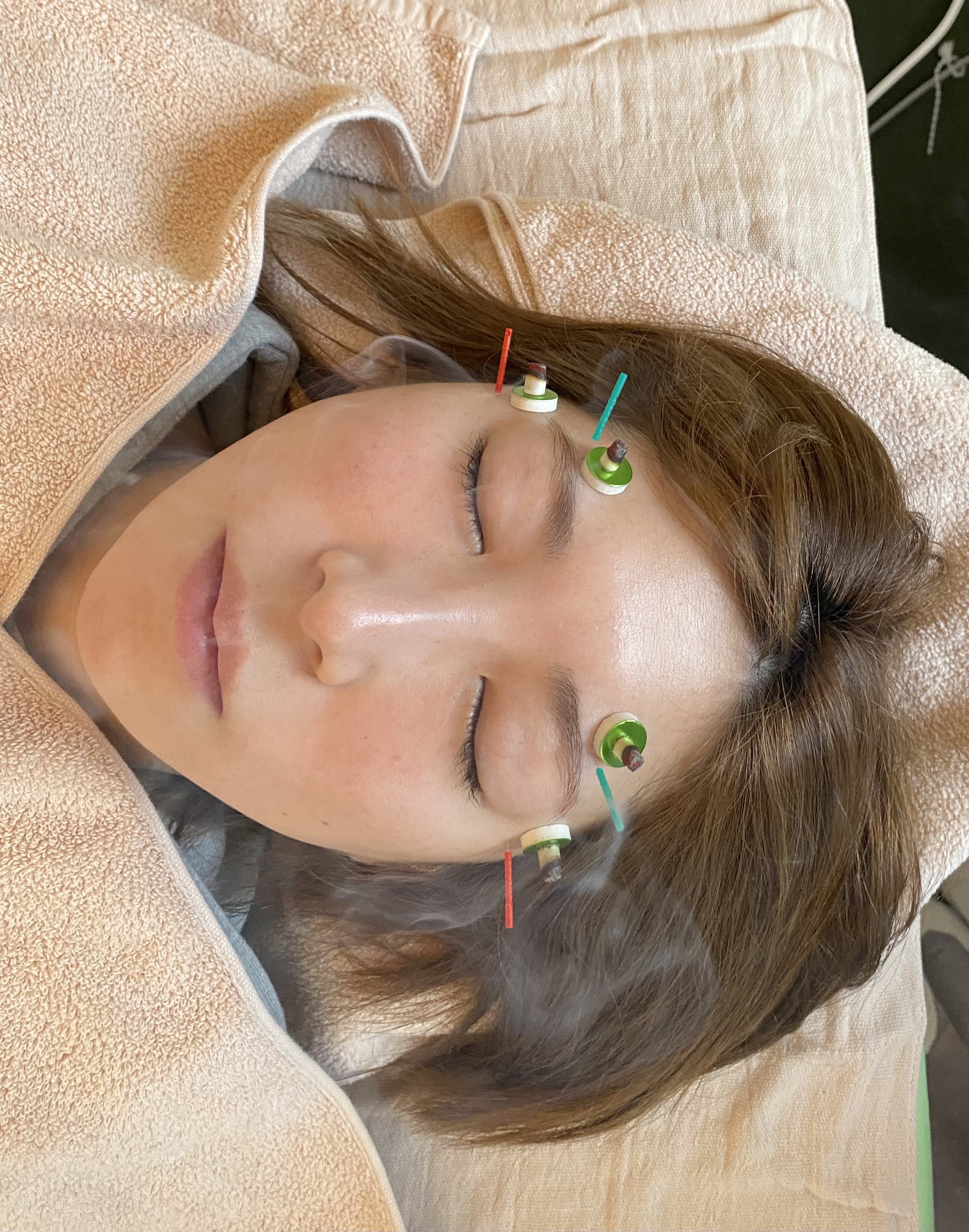 はり灸ソムリエ ポイント美容鍼のメニュー画像