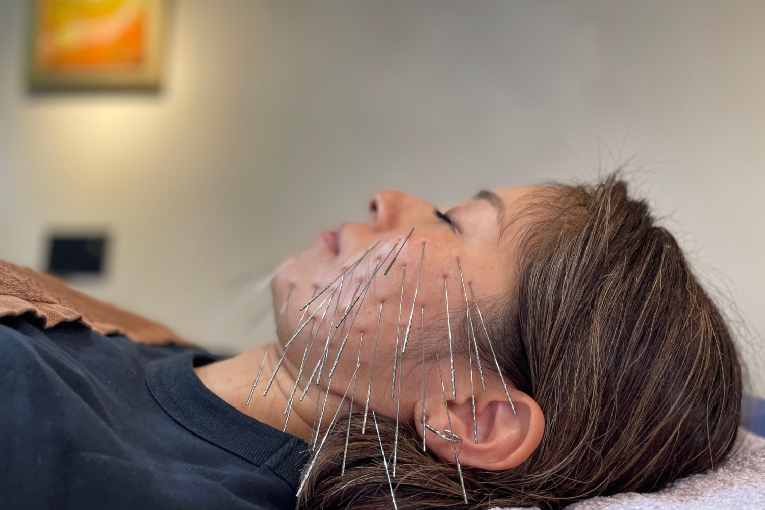 鍼処NAOTO 宮崎出張所 - 小顔整体・慢性症状・神経痛専門ルート鍼治療 - ルート鬼美容鍼【スタンダード】のメニュー画像