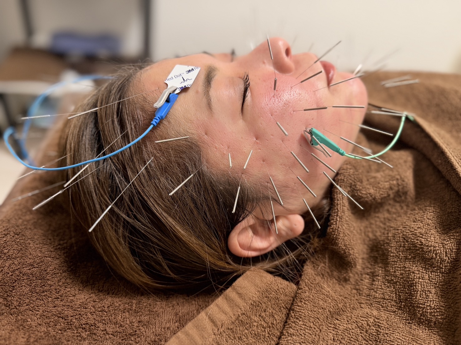 鍼処 紡ぐ 新メニュー⭐️紡ぐ美容鍼【40分】のメニュー画像