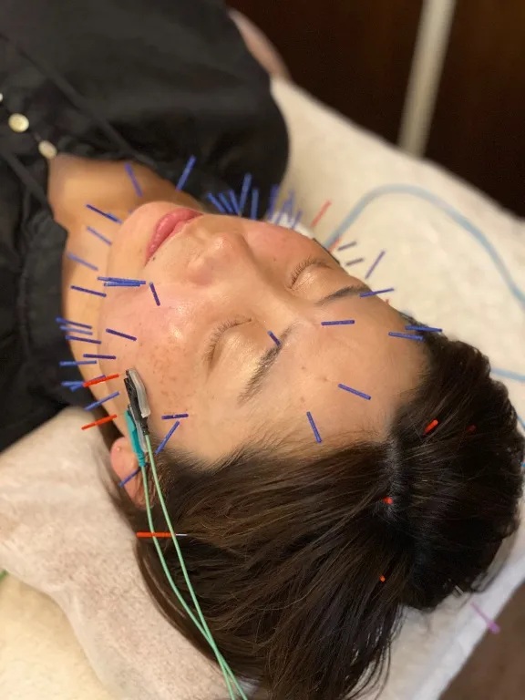 form美容鍼灸院　八丁堀店 電気を流す美容鍼 ＴＲＹのメニュー画像