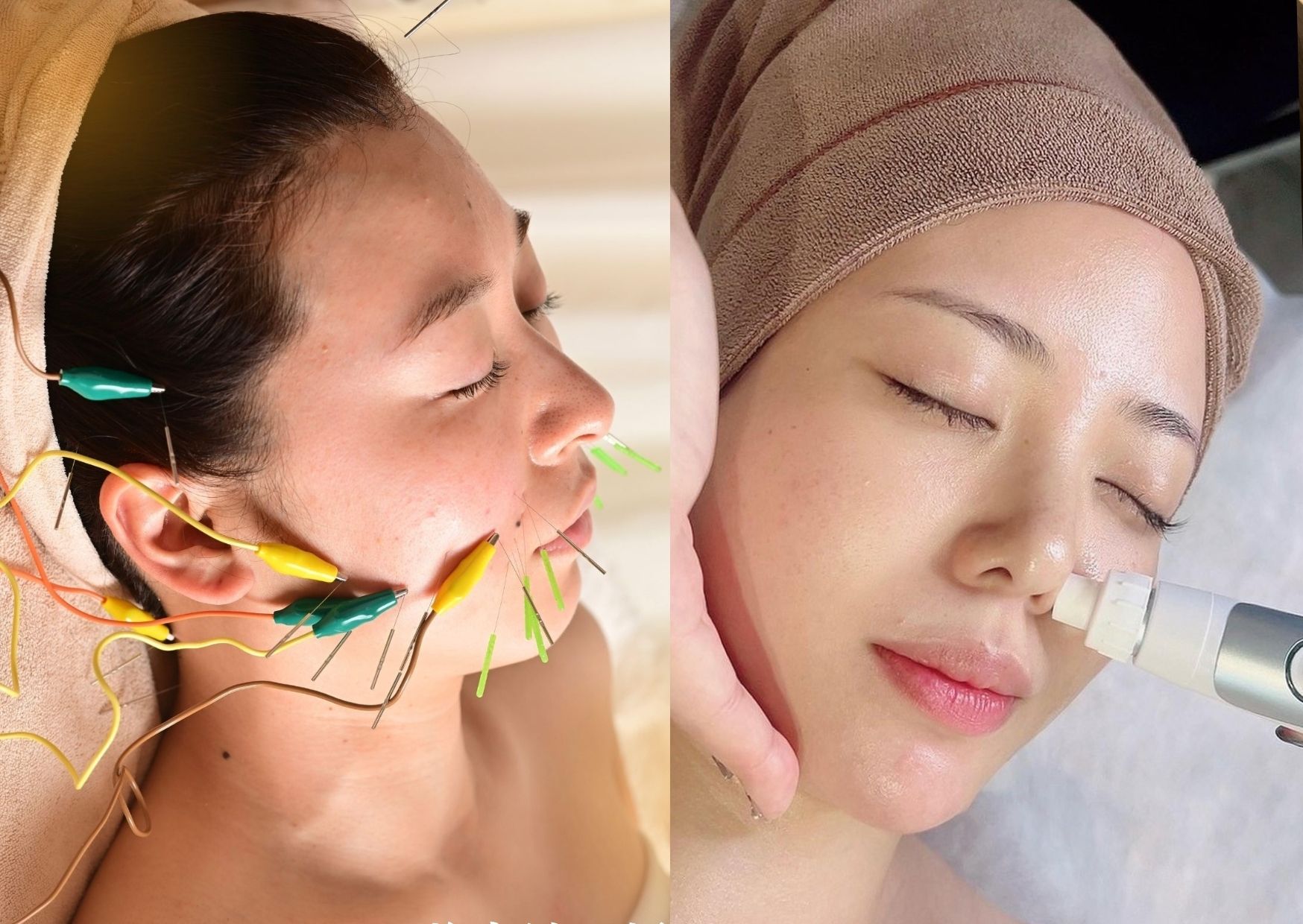 那覇鍼灸サロンrepos［ルポ］ 【毛穴の黒ずみ/開きに】電気美容鍼＋毛穴洗浄&ヘッドのメニュー画像