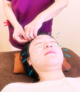 F&E鍼灸院 【初診】美容鍼（別途カルテ作成料＋2,000円がかかります）のメニュー画像