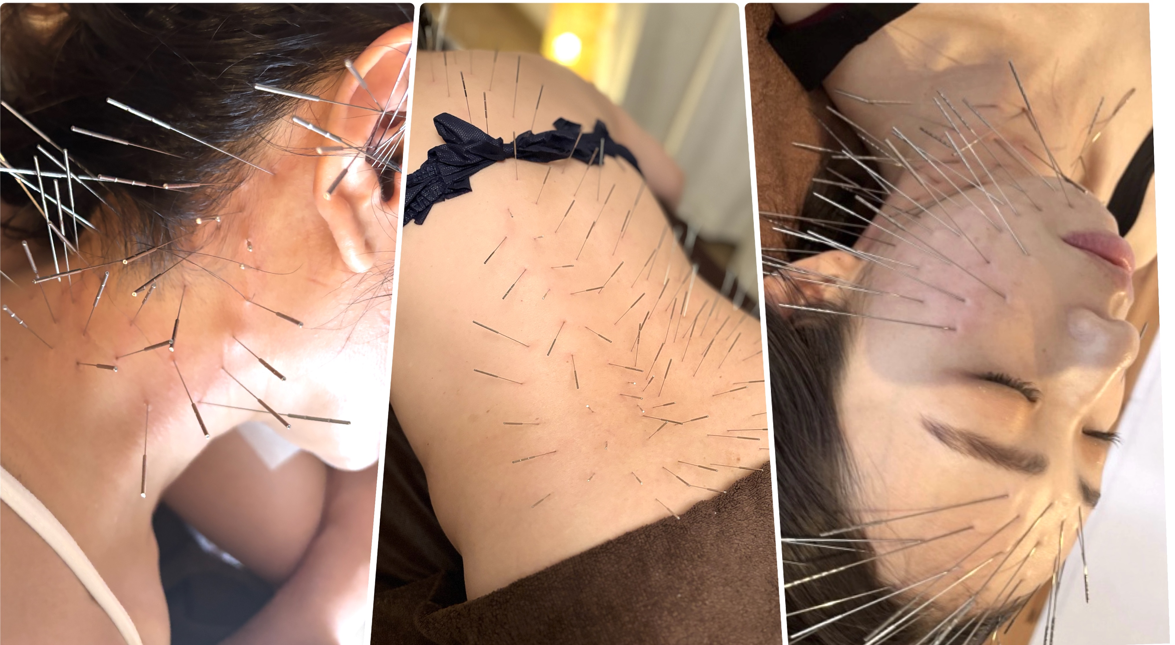 鍼と灸サロンクレド【ルート治療院】大治町本院 【初めての方】ルート治療　90分　⭐︎全身調整⭐︎お身体＋美容鍼のメニュー画像