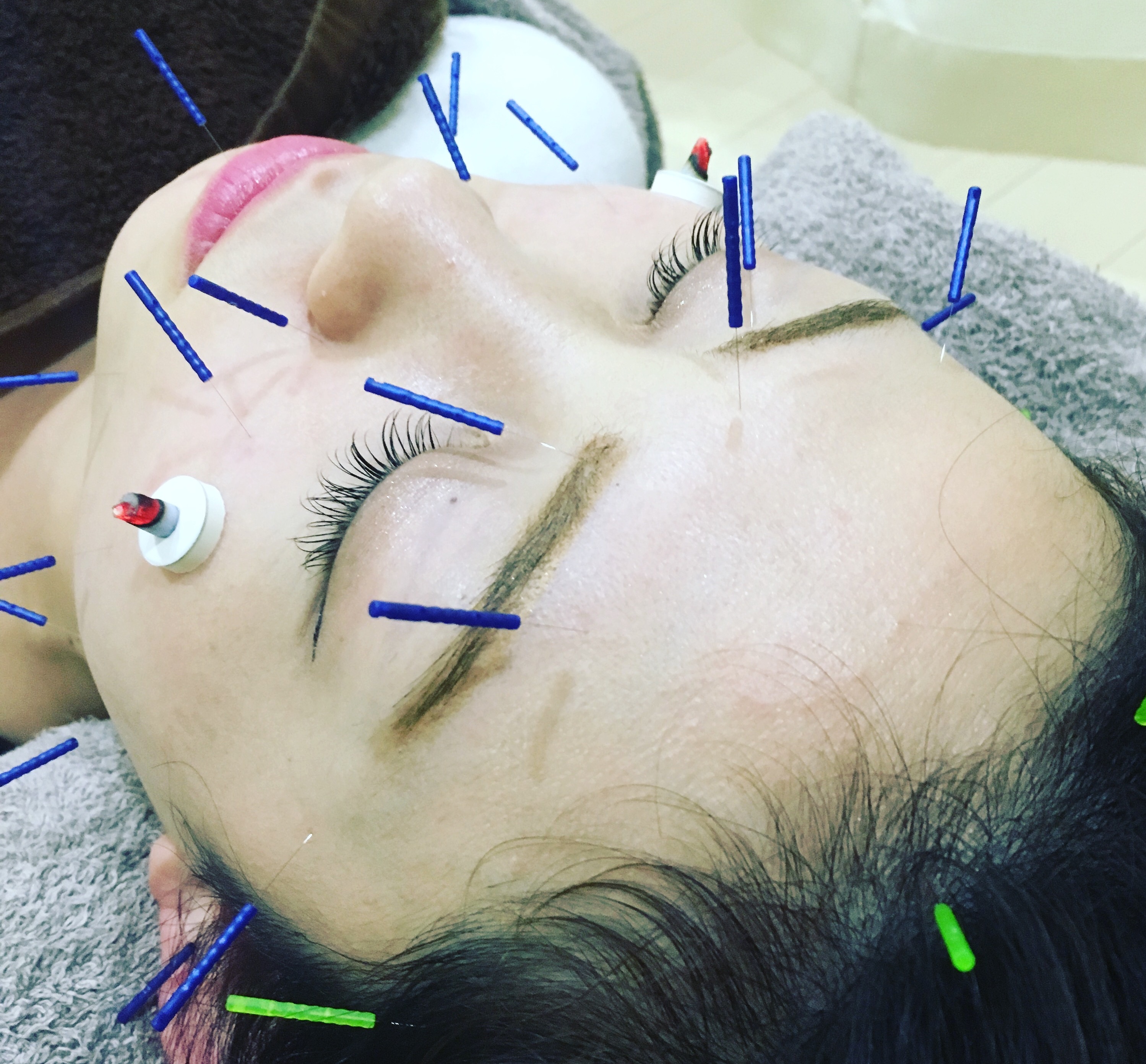 しょう鍼灸整骨院  【一番人気】美容鍼：深部温熱ラジオ波＆リフトアップ（70分）のメニュー画像