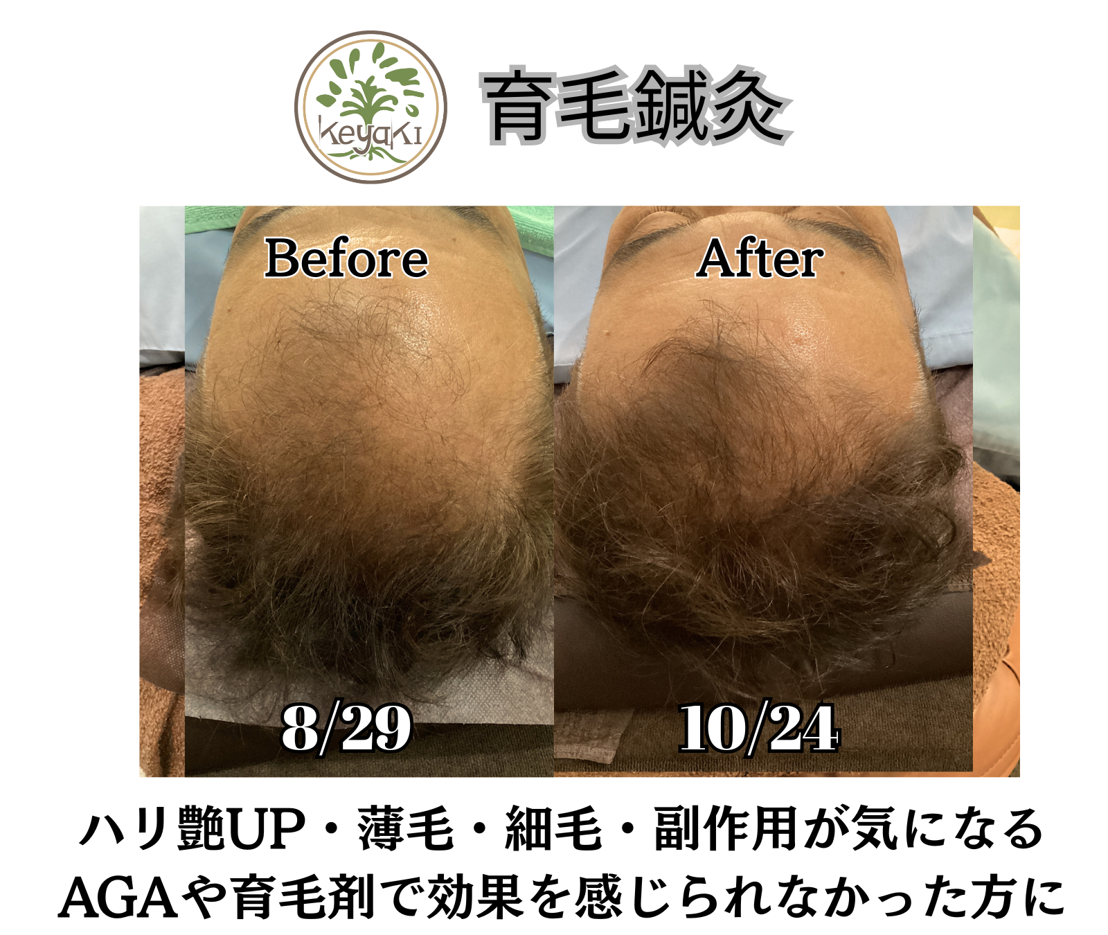 鍼灸・美容鍼サロンKEYAKI　自由が丘院 【初回限定】育毛鍼の効果を実感5回パック ★セルフケア用育毛鍼ローラー付★のメニュー画像