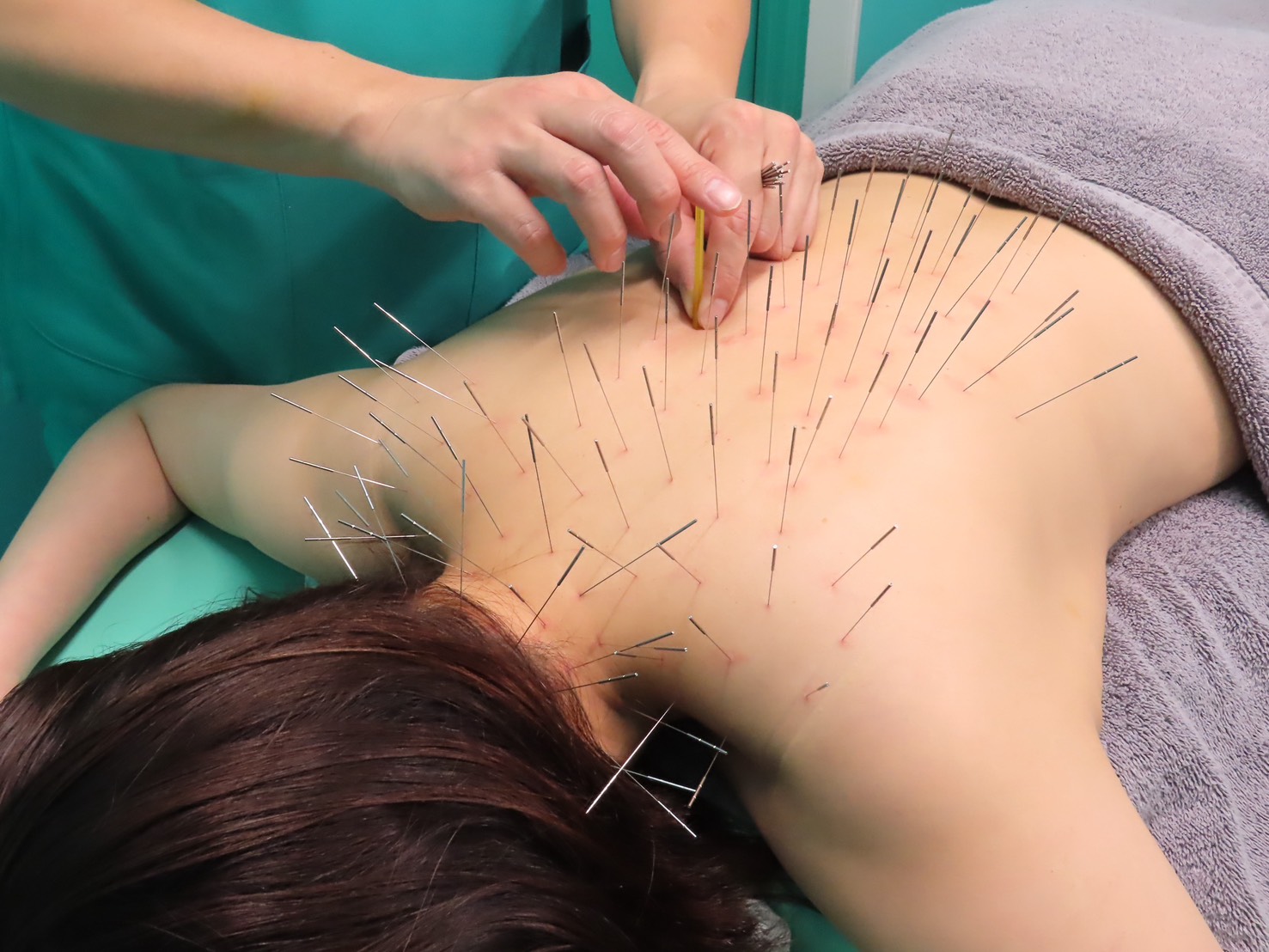 高宮レディース鍼灸整骨院 【初回限定】鍼施術(ルート鍼)60分　¥16,500→¥4,980のメニュー画像