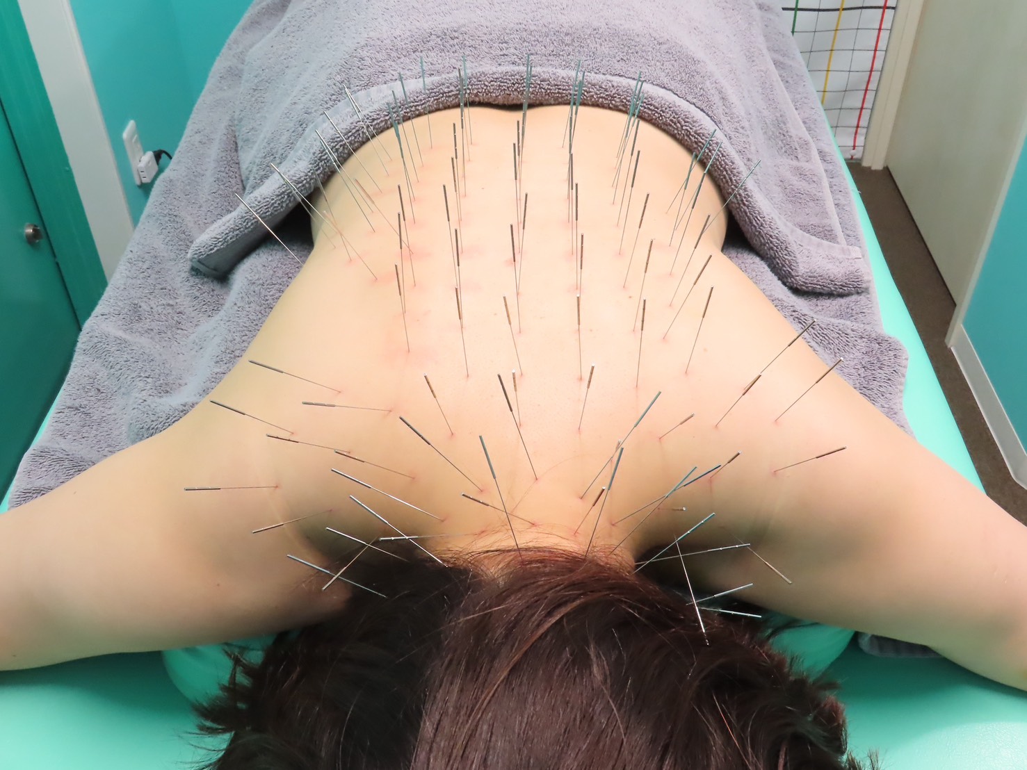 高宮レディース鍼灸整骨院 鍼施術(ルート鍼)60分のメニュー画像