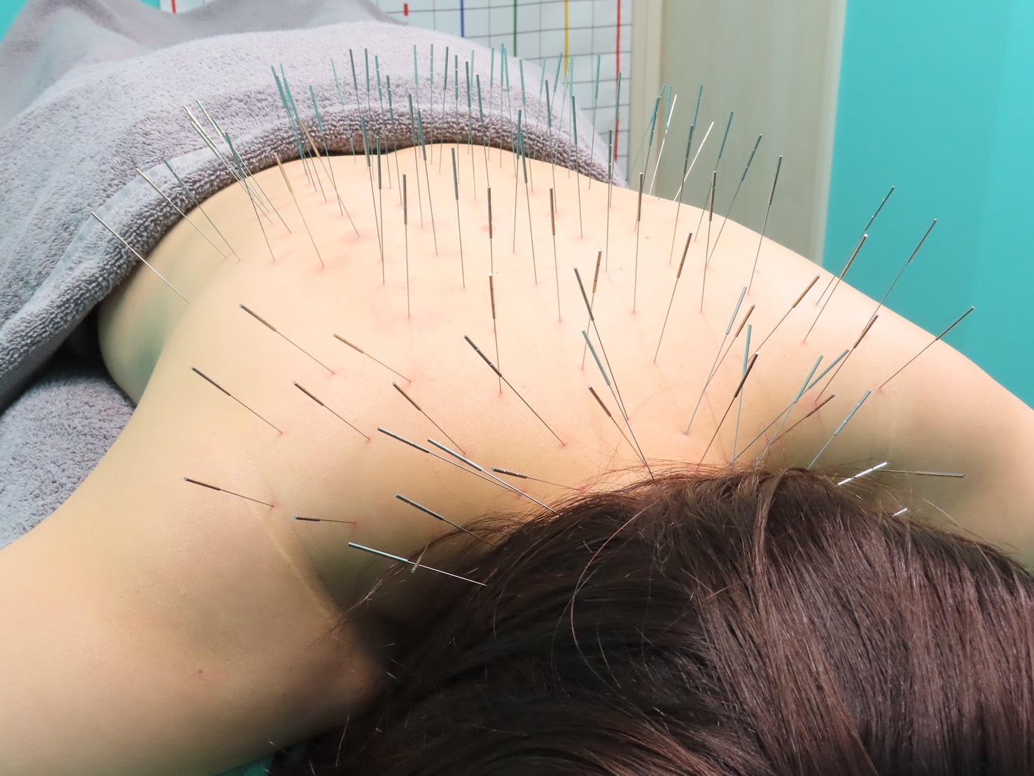 高宮レディース鍼灸整骨院 【初回限定】鍼施術(ルート鍼)30分のメニュー画像