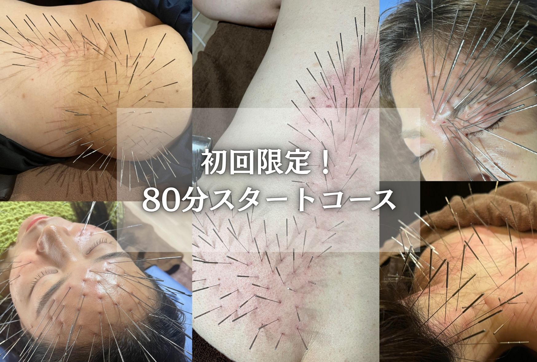 鍼処 紡ぐ 【初回限定】ルート治療スタートコースのメニュー画像