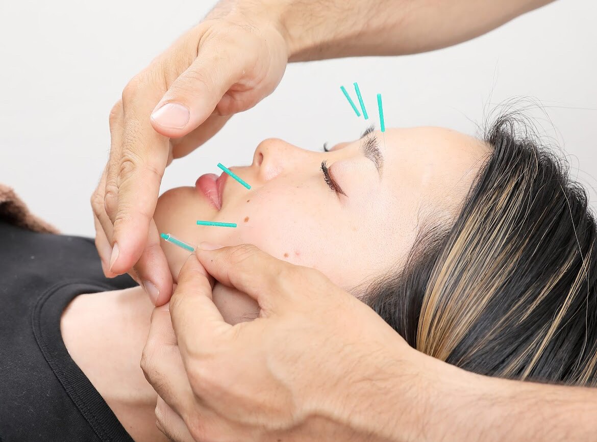 鍼灸院LINDA 【癒しの美容鍼】しわ/たるみ/くすみ/むくみ改善に◎のメニュー画像