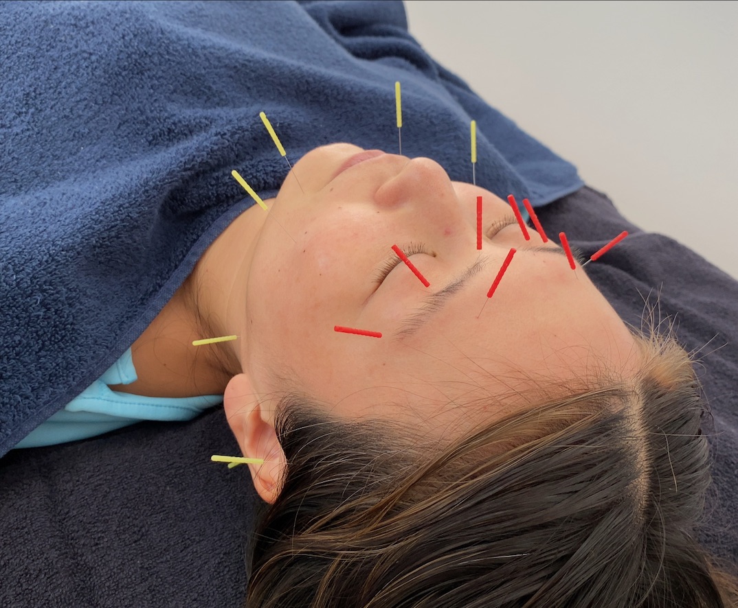 はり・きゅう・あんまマッサージ指圧治療院 癒鎮 【内側から輝く美しさへ】ハリウッドスタイル美容鍼　2回目以降のメニュー画像