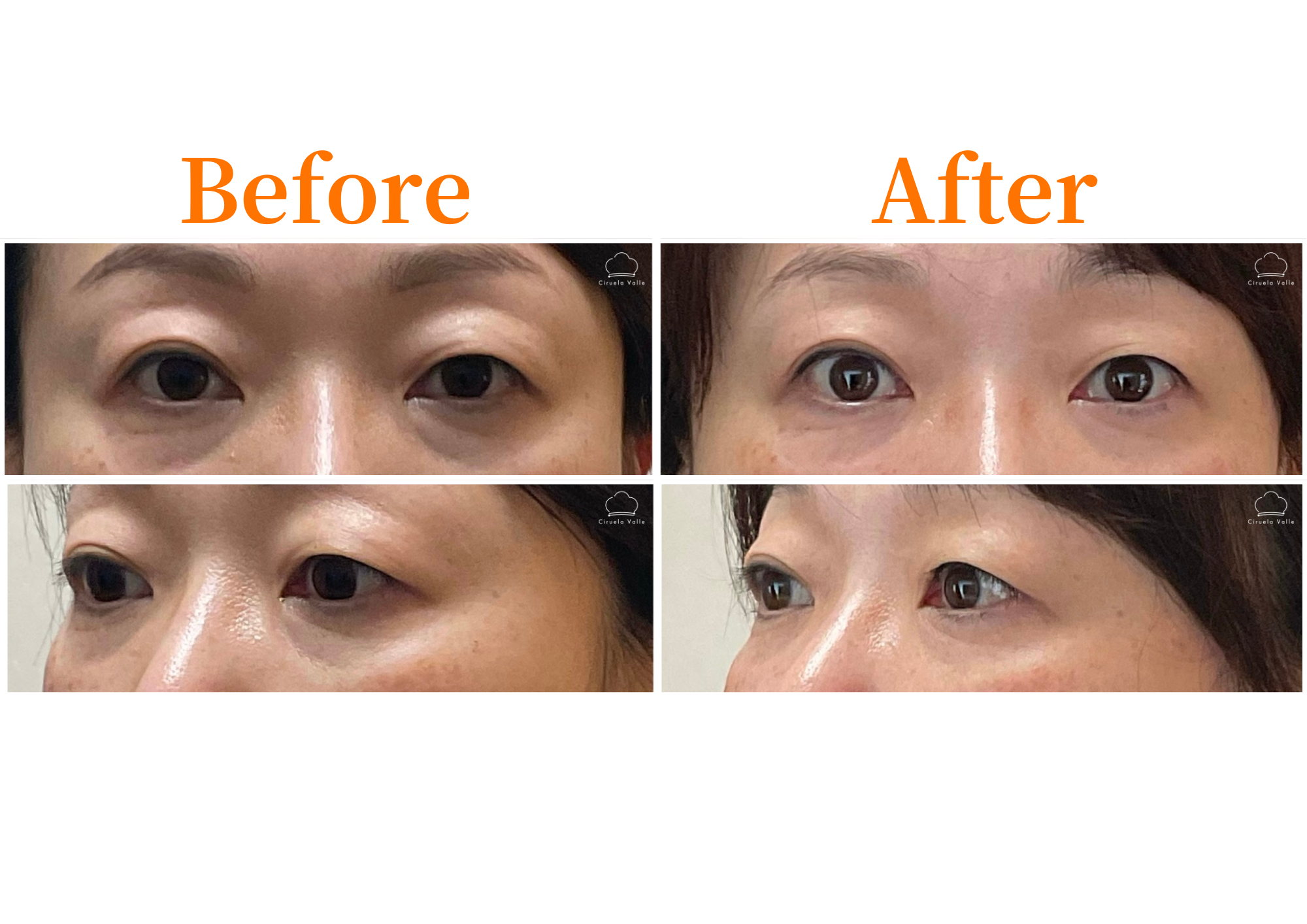 −美容鍼・小顔専門−鍼灸CiruelaValle 残り1名【目元/口元のたるみ】『たるみ改善美容鍼』初回3000円のメニュー画像