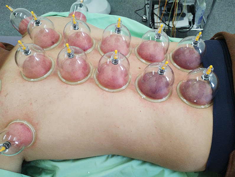 楽楽鍼灸院・整骨院 【新生活応援キャンペーン!!】30分以上のメニューで初診料割引＋カッピングサービスのメニュー画像