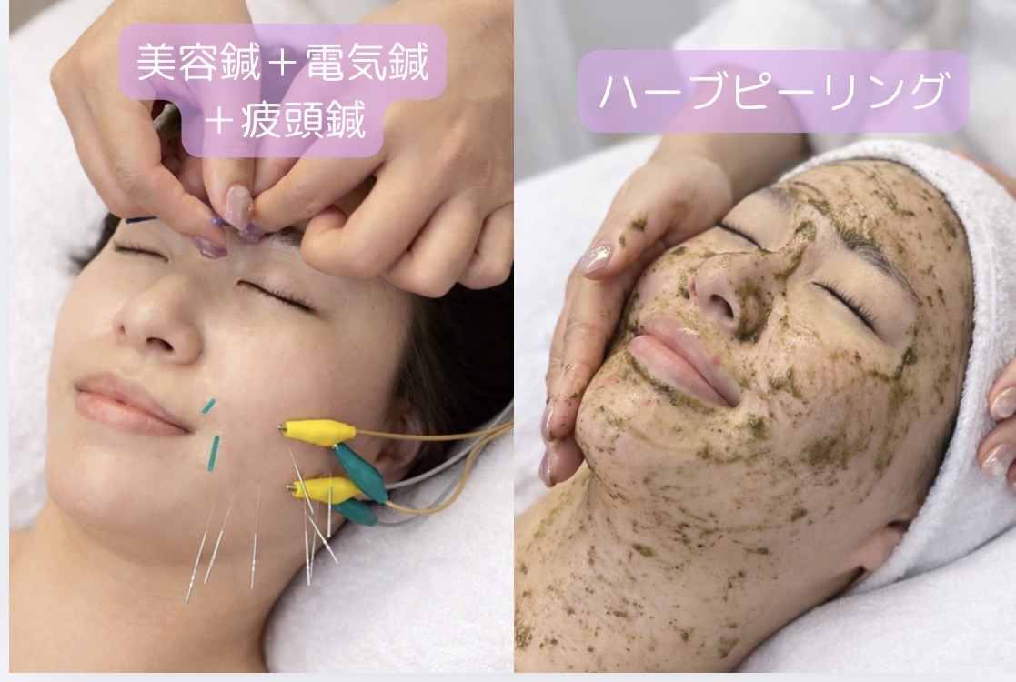 鍼灸サロン Hari-Cure 4月限定【小顔リフトアップ＋肌改善艶アップ】美容鍼+W電気鍼+ハーブピーリングのメニュー画像