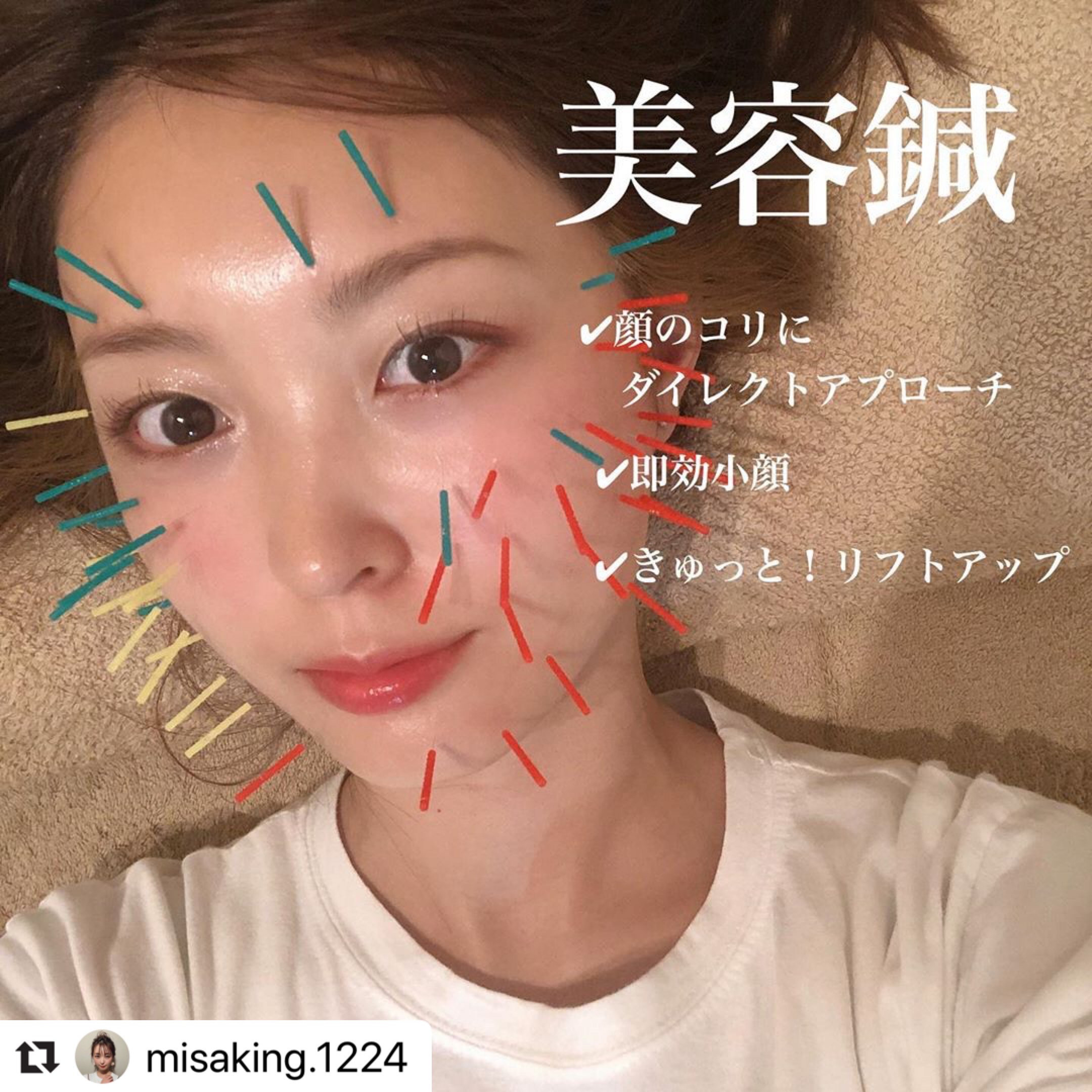 鍼灸整骨院Refine 美容鍼施術　初回体験￥12000→￥4980のメニュー画像