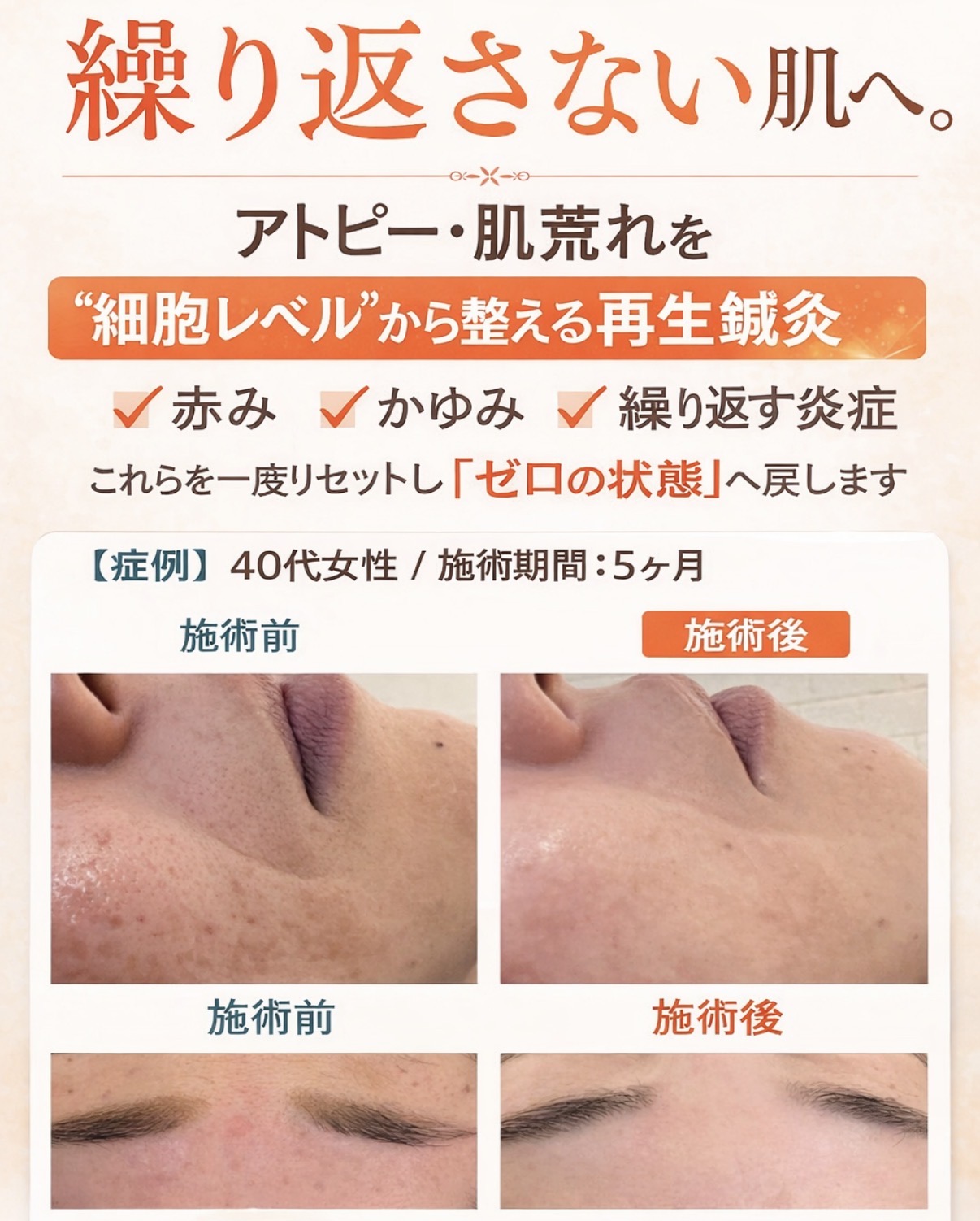 HaRick 美容鍼灸整体 【アトピーのお悩み】鍼灸＋カウンセリング　体質から整えるケア　初回2980円のメニュー画像