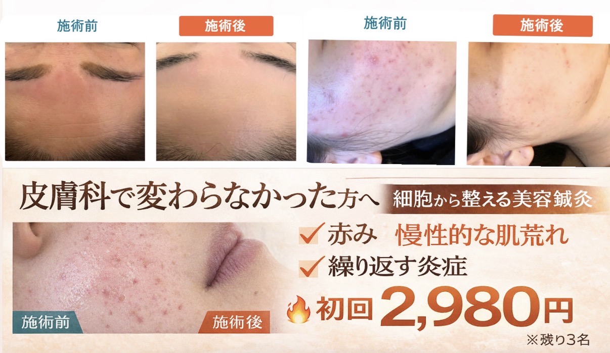 HaRick 美容鍼灸整体 【アトピーのお悩み】鍼灸＋カウンセリング　体質から整えるケア　初回2980円のメニュー画像