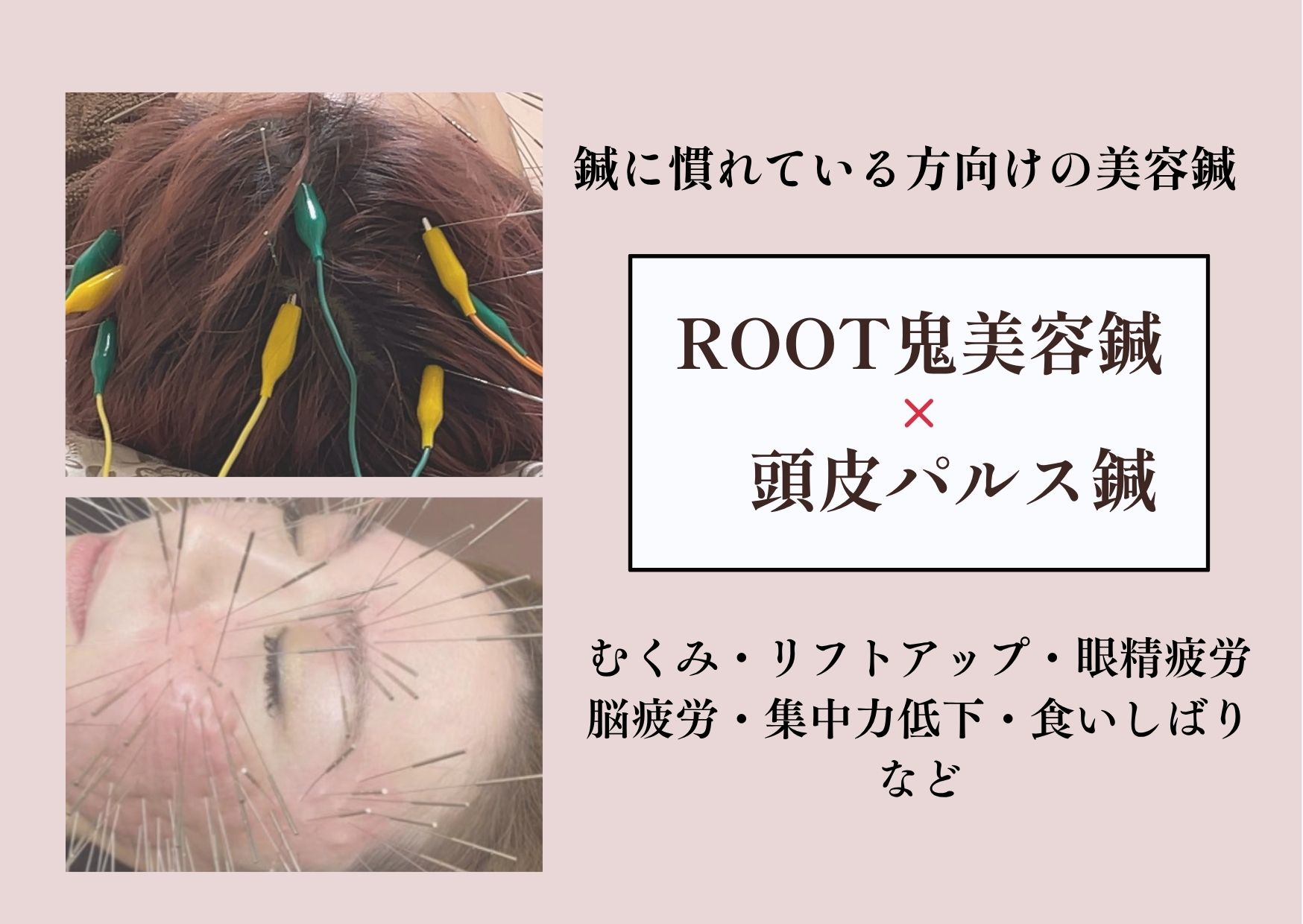 ゆり鍼灸院 ROOT美容鍼×頭皮鍼（パルス有/無し選択可）のメニュー画像