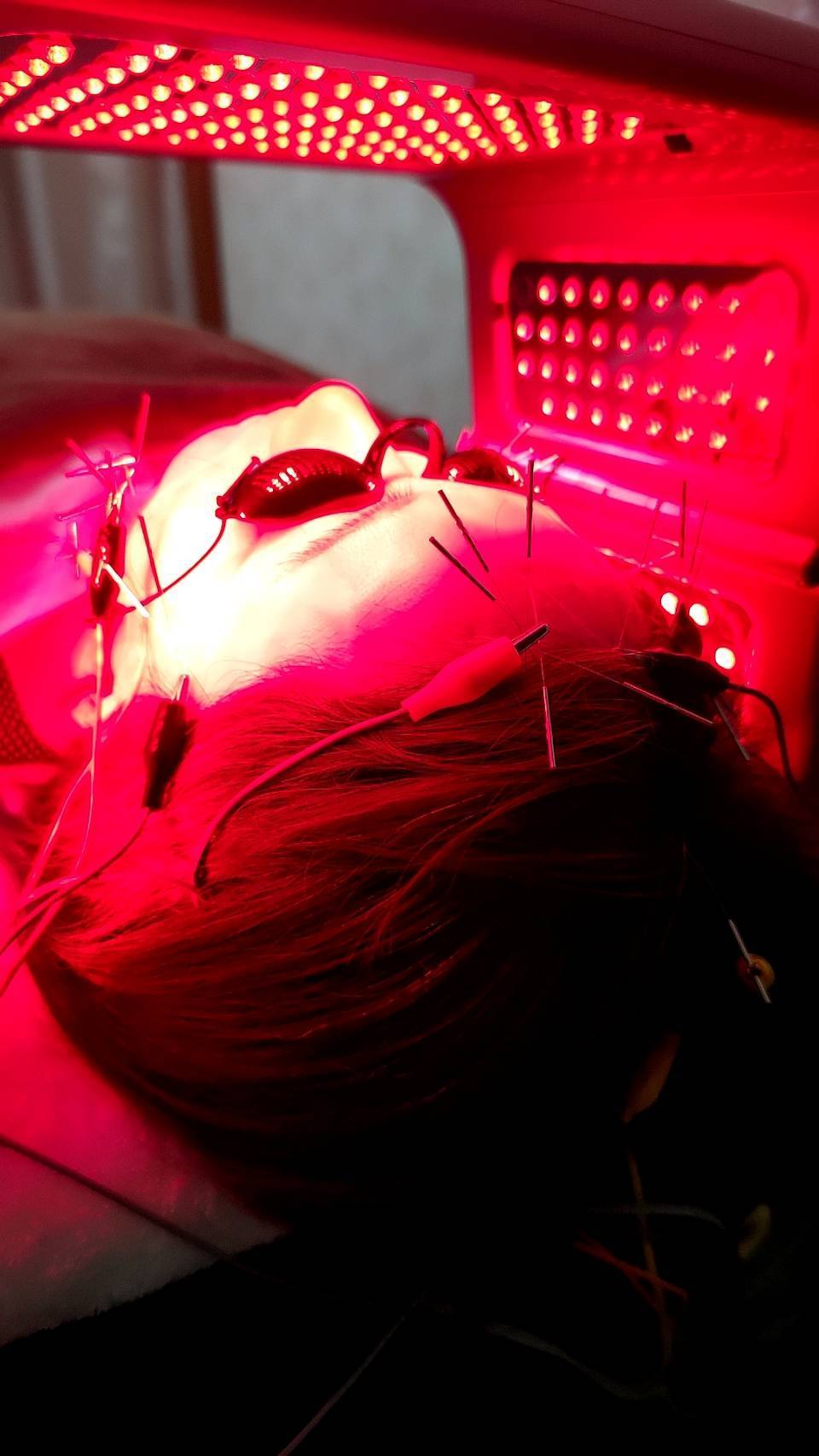 笹岡尚幸鍼灸院　電気を流す美容鍼 ＬＥＤのメニュー画像