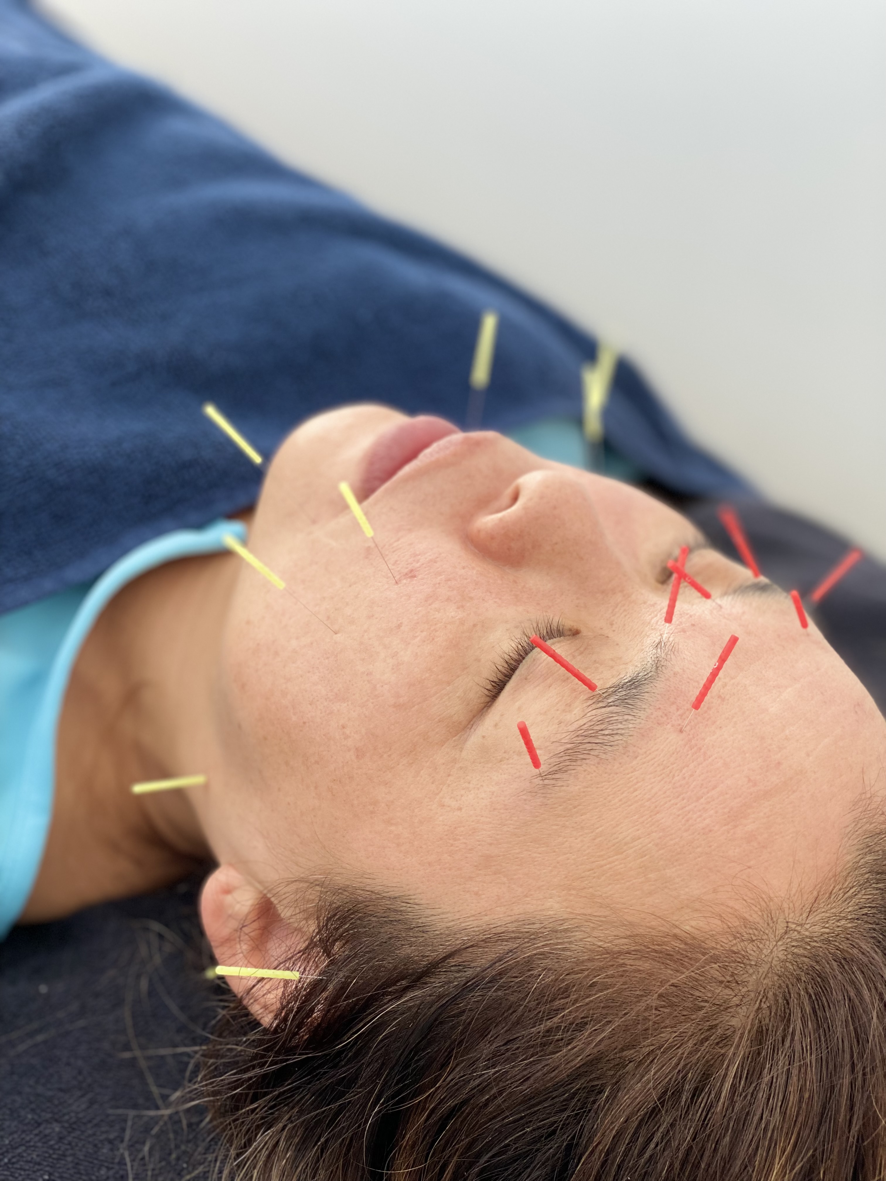 はり・きゅう・あんまマッサージ指圧治療院 癒鎮 【内側から輝く美しさへ】ハリウッドスタイル美容鍼　初めての方のメニュー画像