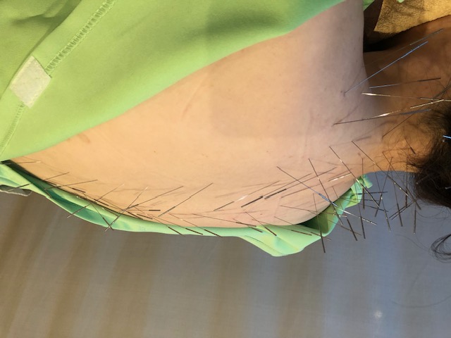 totonou鍼灸治療院 ルート治療(デラックス)のメニュー画像