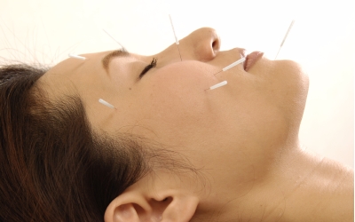 【オトナ女子の為の】美容鍼×ラジオ波で叶える　|なごみ鍼灸整骨院|　 【独自技術】高麗手指鍼　美容鍼単体　眼精疲労にものメニュー画像