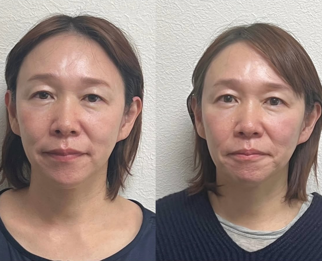 ルート治療・空ルート専門院　鍼処かなしゃ 鬼美容鍼30分コースのメニュー画像