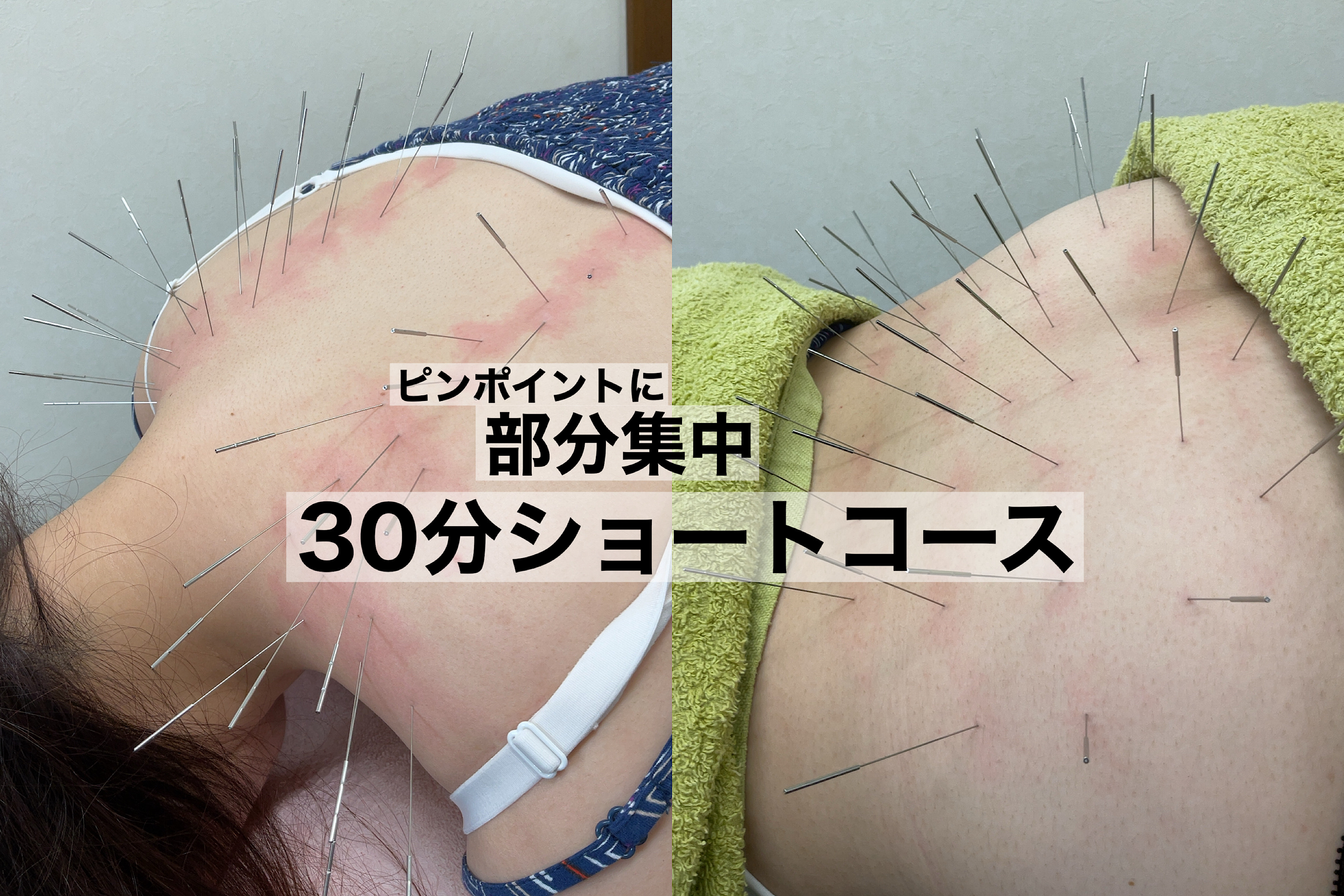 みやけ鍼灸院（ルート治療） ルート治療30分　ショートのメニュー画像