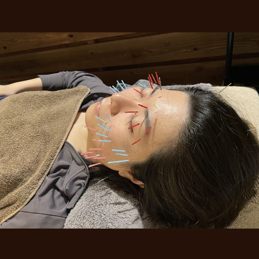美容鍼灸サロン〜MIYABI〜 エラ張り改善　【美容鍼×首肩コリ施術セットメニュー】のメニュー画像