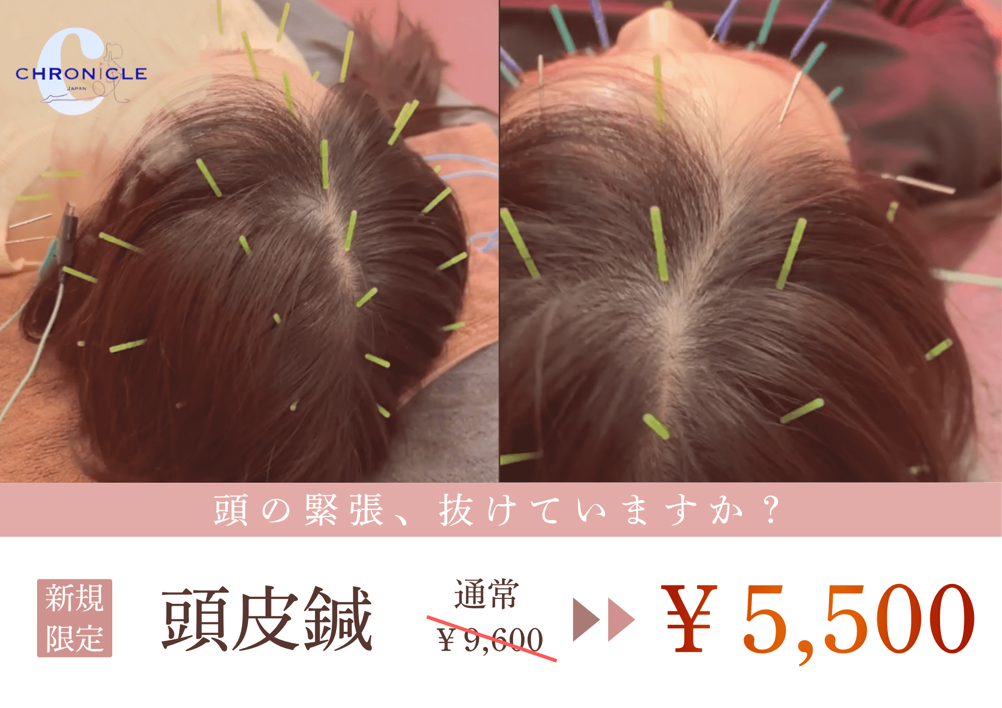 CHRONICLE鍼灸院 【頭痛・眼精疲労などに◎】電気頭皮鍼施術＋頭もみほぐしのメニュー画像