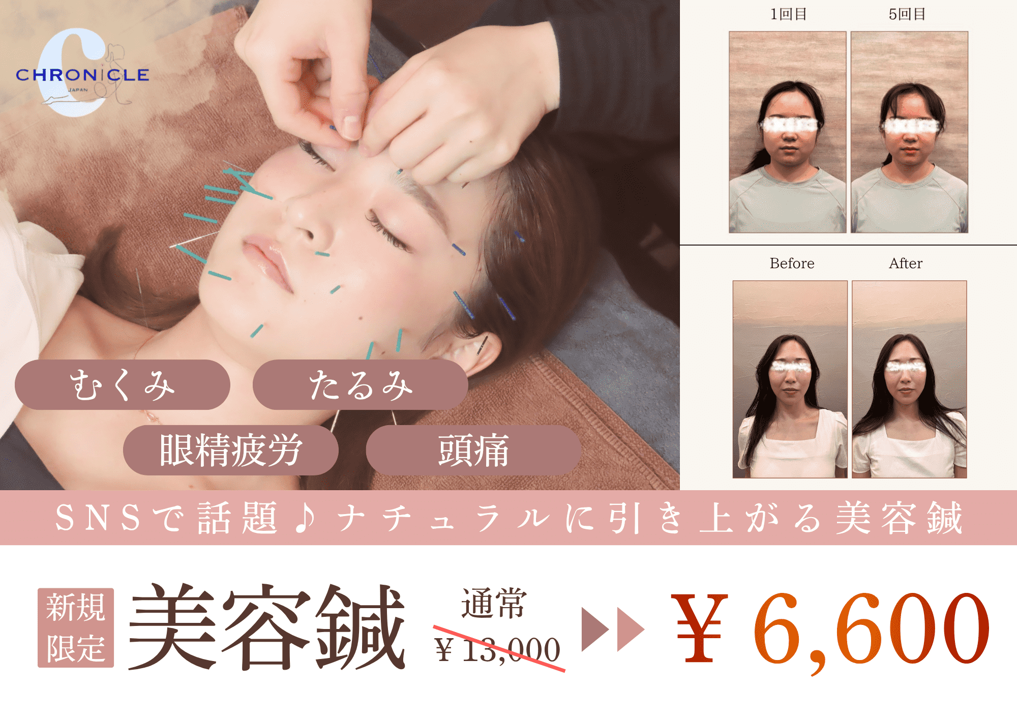CHRONICLE鍼灸院 【リフトアップ・むくみ解消☆】電気美容鍼灸＋頭皮もみほぐしのメニュー画像
