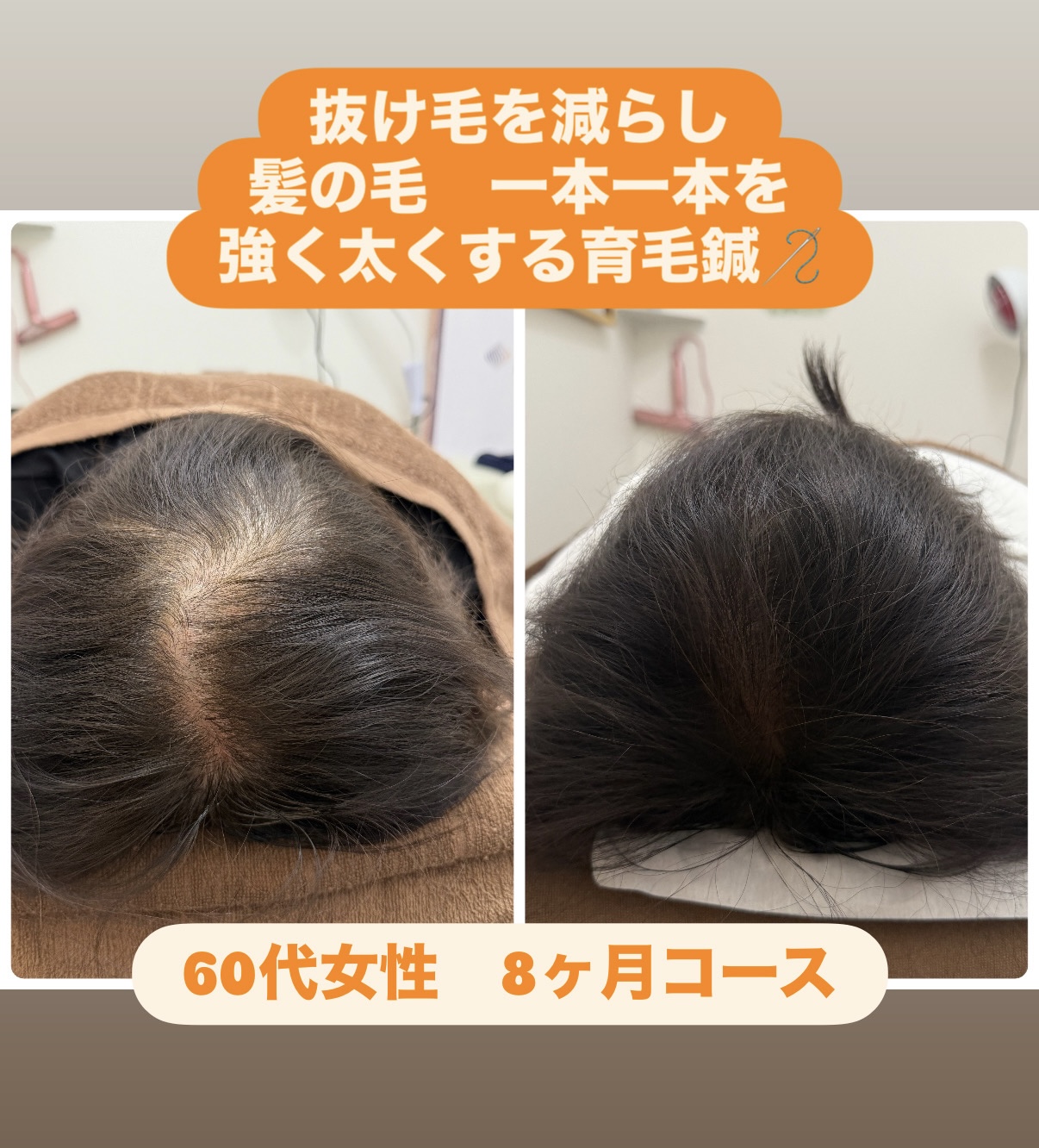 れもんせっこつ院・鍼灸院 【人気NO.1】月3名限定カウンセリング＆ 初回体験 育毛促進鍼27500円→4980円/抜け毛/薄毛/細毛/円形脱毛症 のメニュー画像