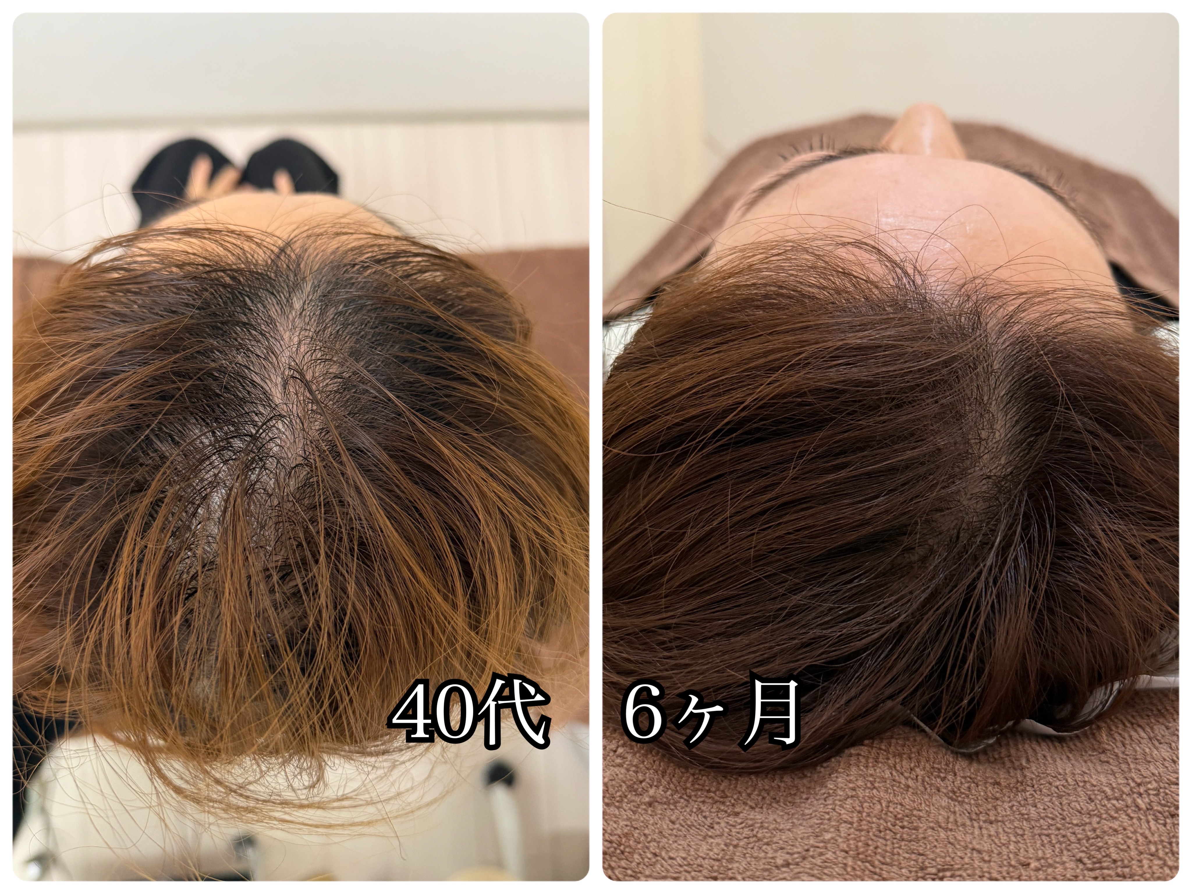 れもんせっこつ院・鍼灸院 【初回体験価格】 育毛促進鍼/抜け毛/薄毛/細毛/円形脱毛症￥27500→ ￥5980のメニュー画像